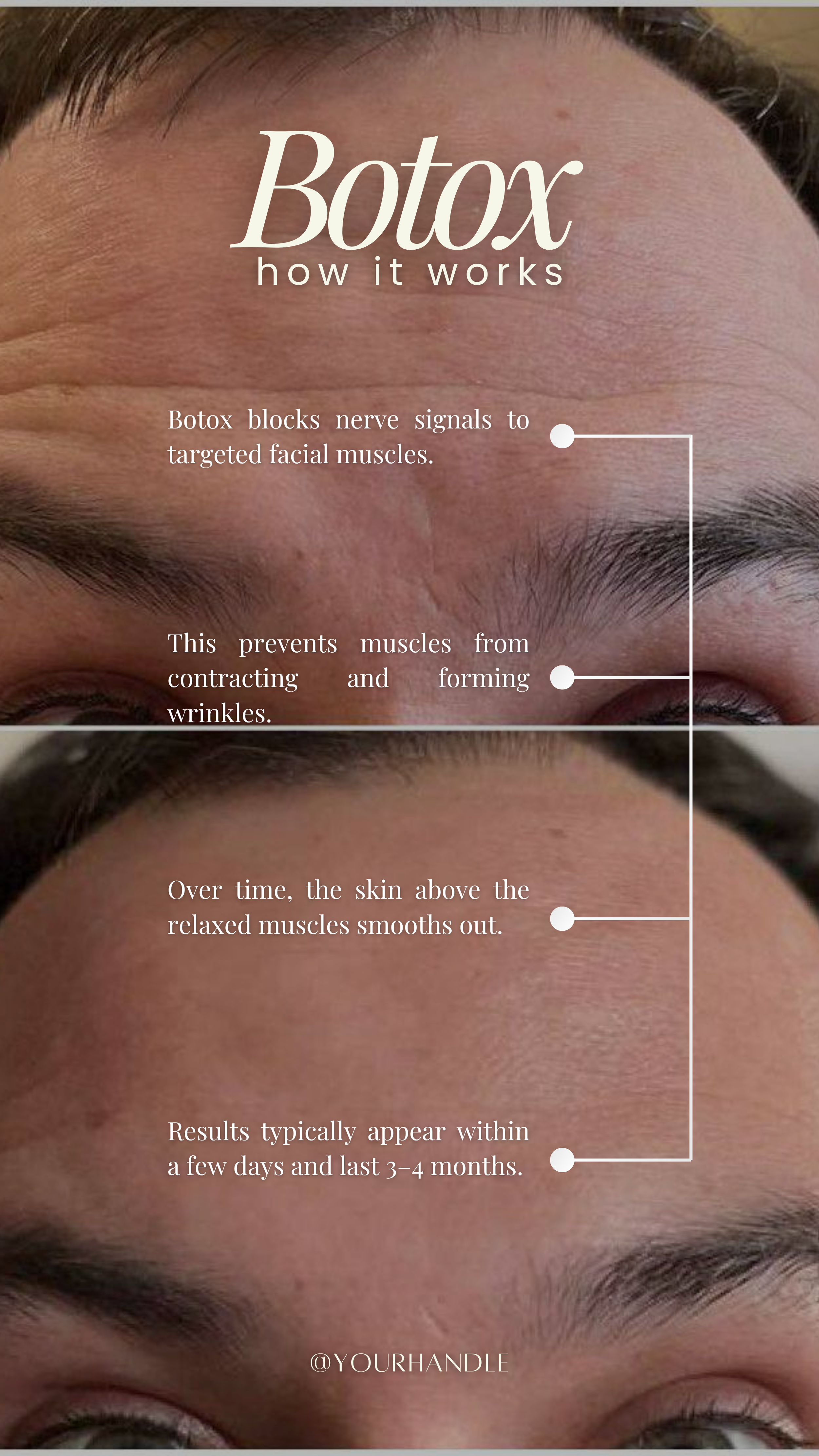 60 units upper forehead