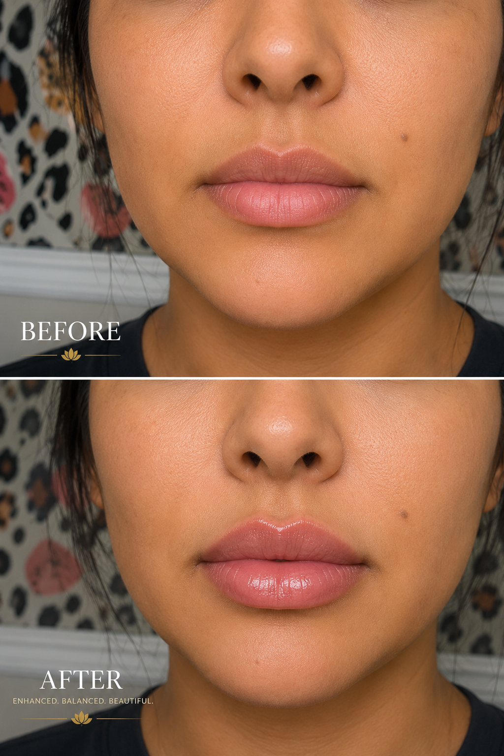 1 Syringe of Lip Filler for Natural looking results