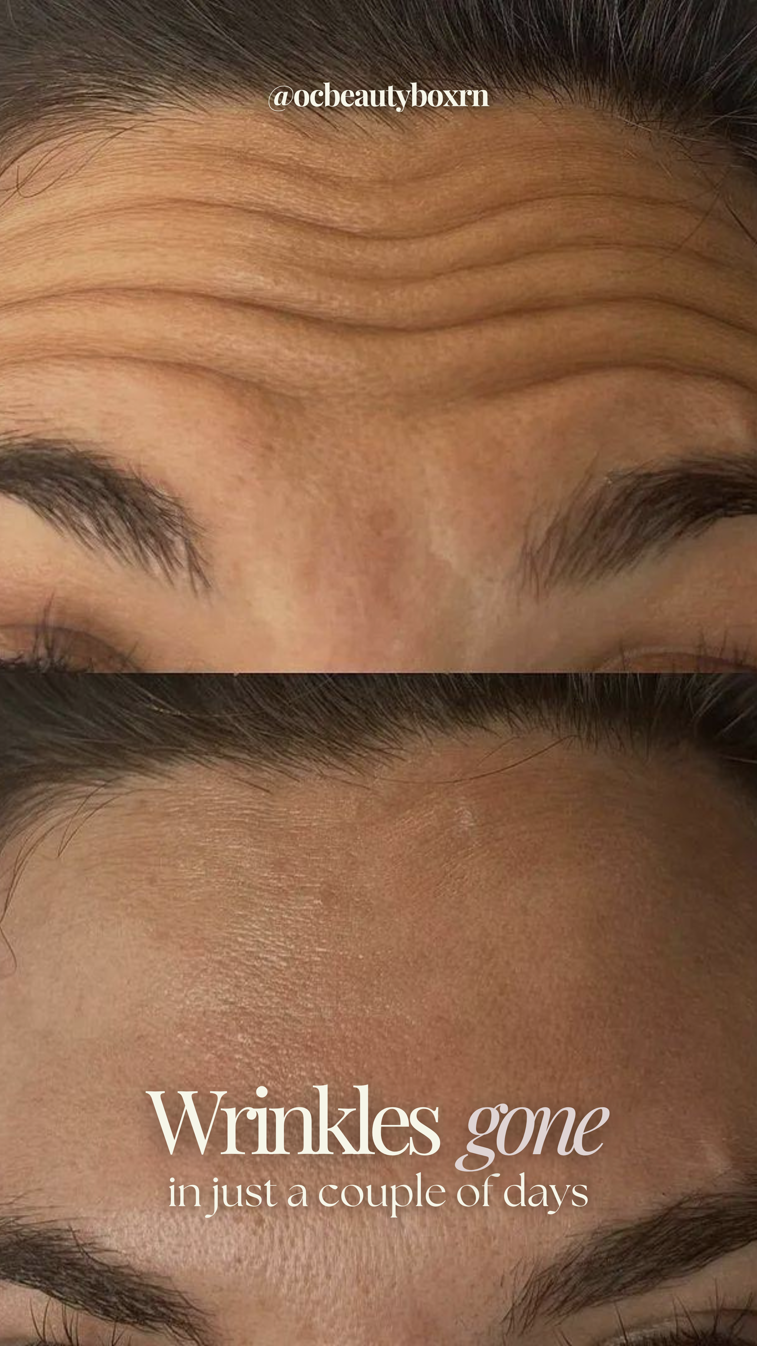 120 Units Dysport- 60 units Glabella (11's) and 60 units upper forehead