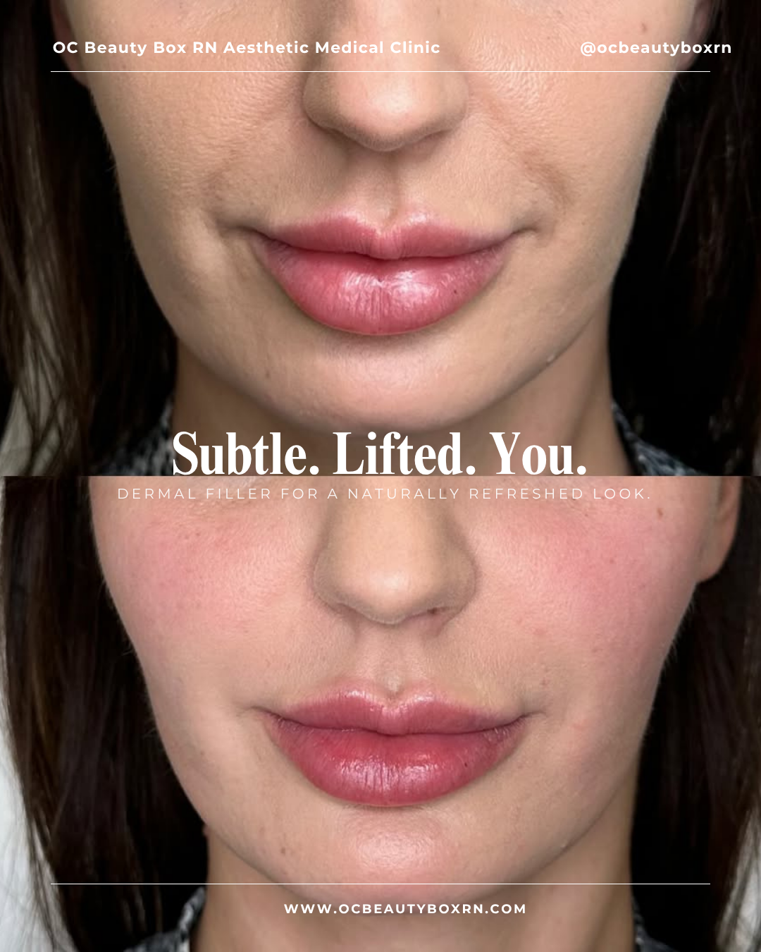 1 Syringe Nasal Labial Fold Crease Filler 1/2 Bilateral
