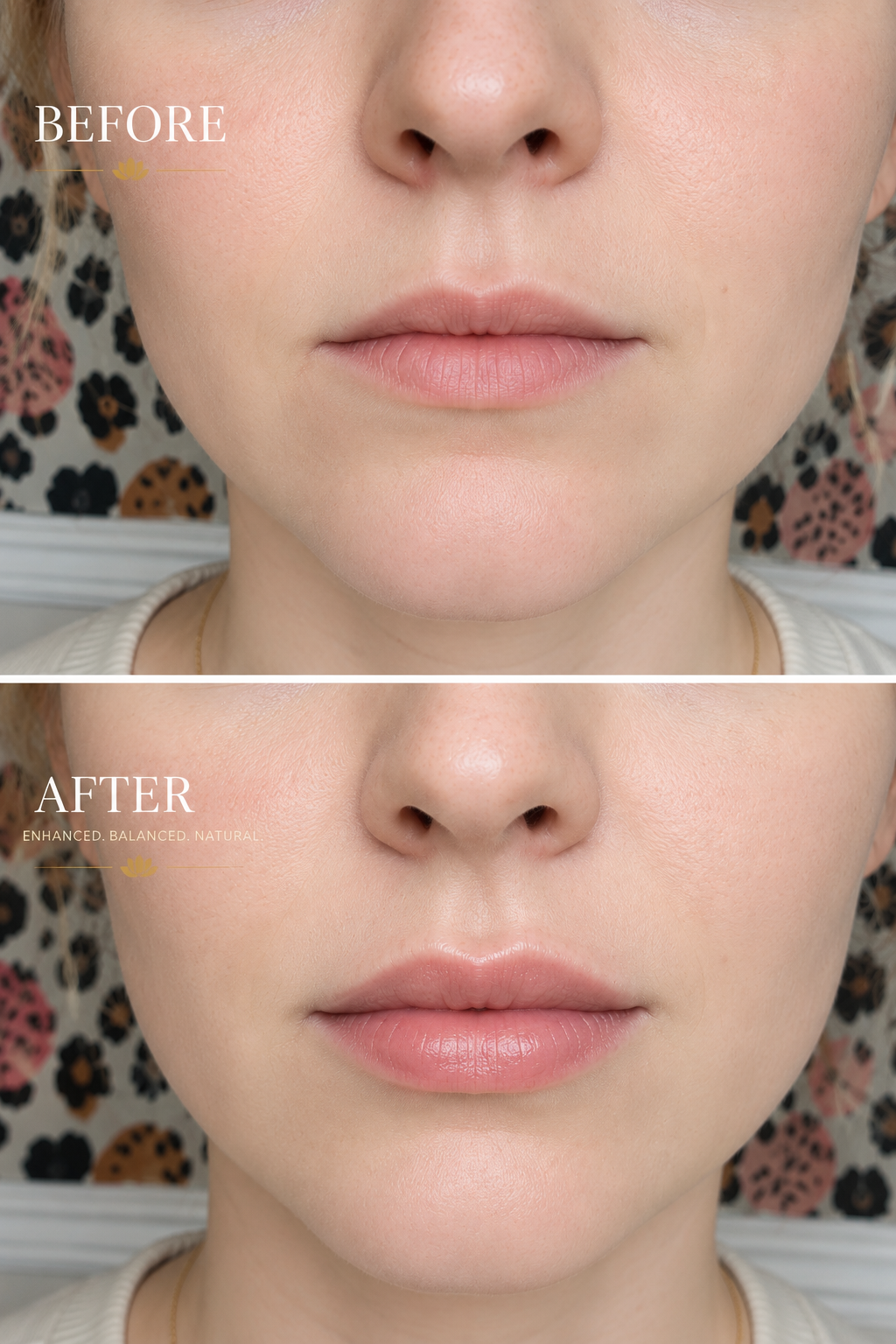 1 Syringe of Lip Filler