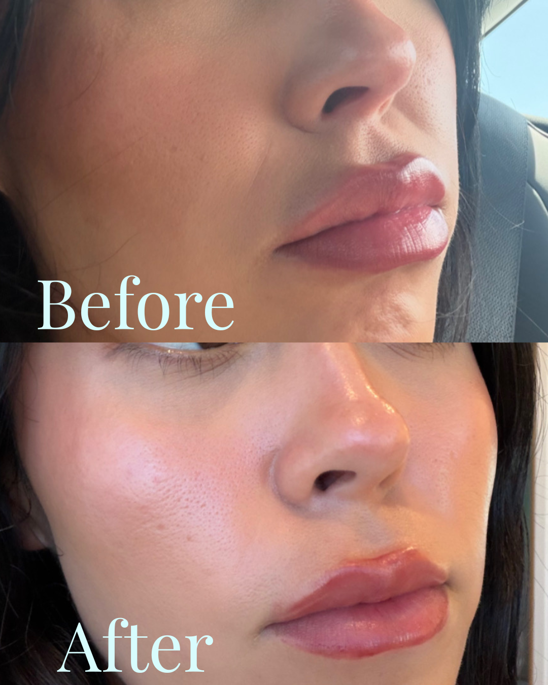 Nasal Labial Crease and Cheek Filler Facial Balancing