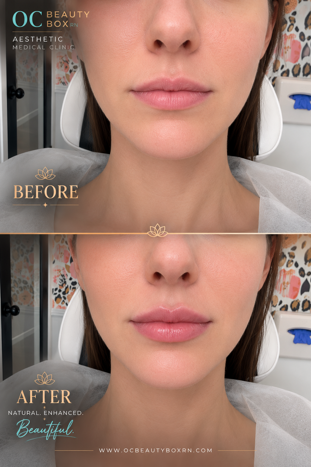1 Syringe of Lip Filler