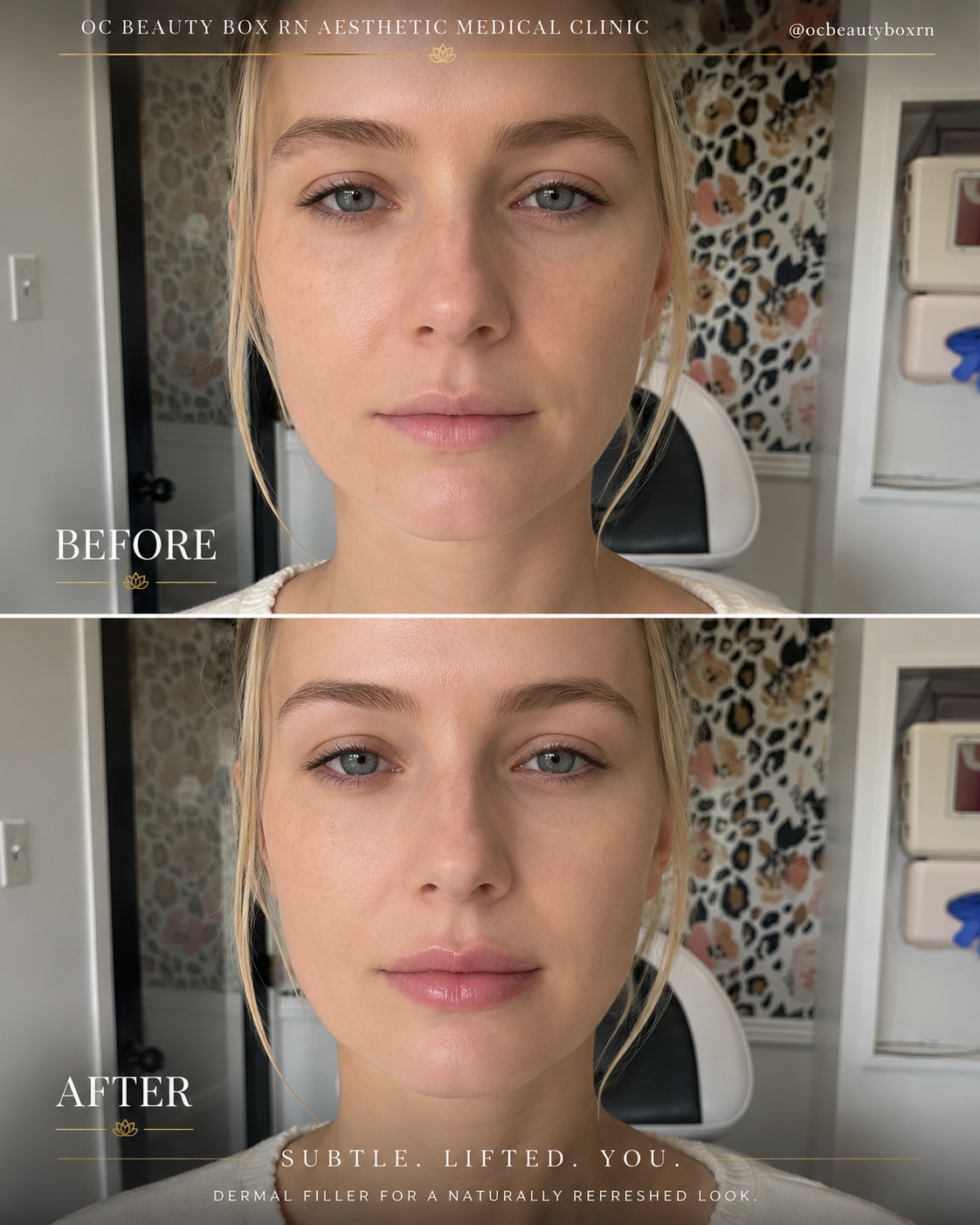 1 Syringe Lip Filler