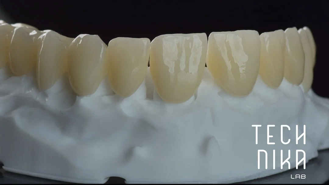 Diastema - dla jednych pacjentów nieakceptowalna, inni ją kochają! Jedna rzecz jest bezsprzeczna - dodaje niepowtarzalny akcent w uśmiechu.
Pacjent, którego dziś przedstawiamy przyszedł do nas z diastemą i mocno startymi zębami oraz za