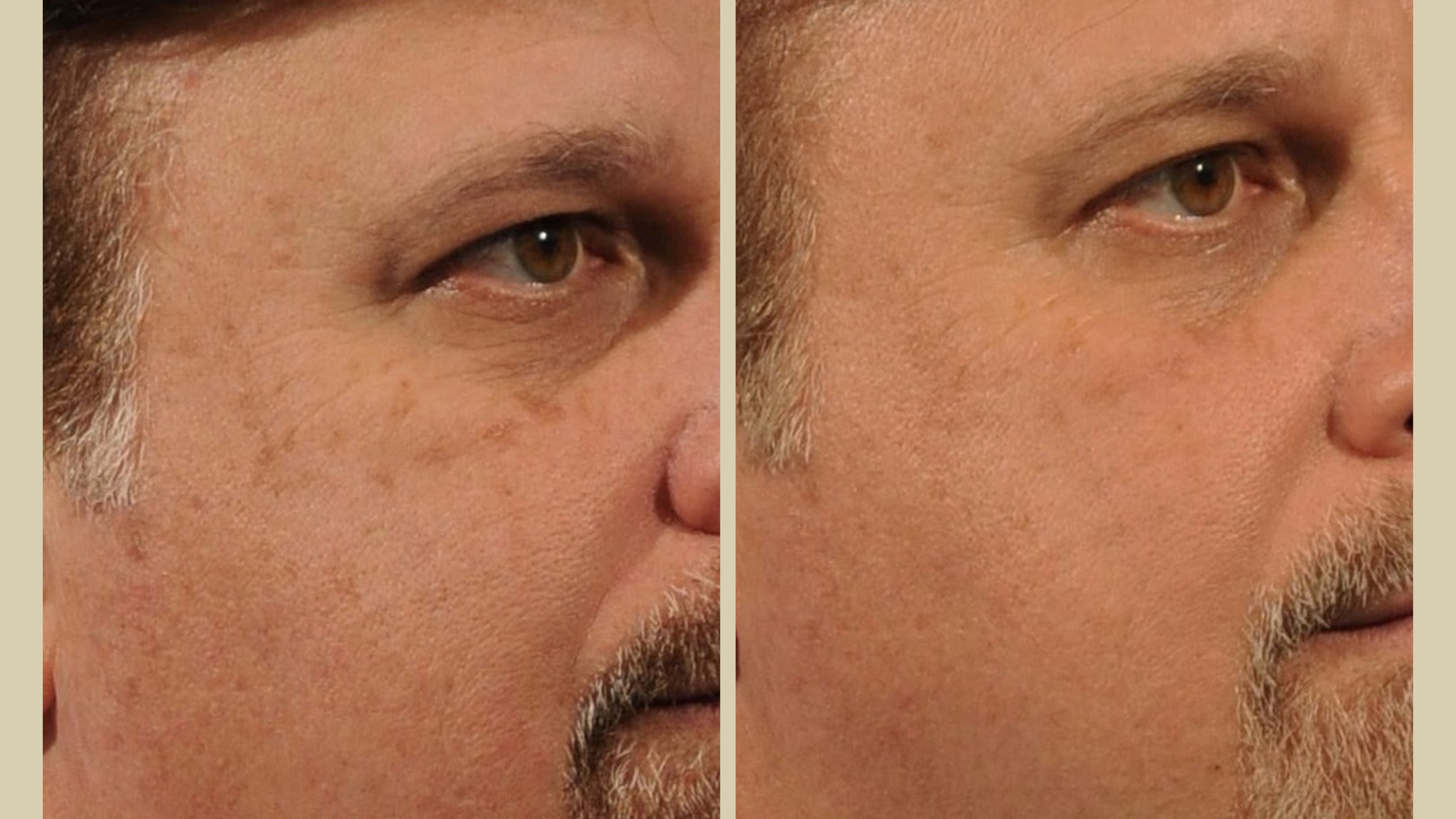 Ultra B&A - 1T (2).png