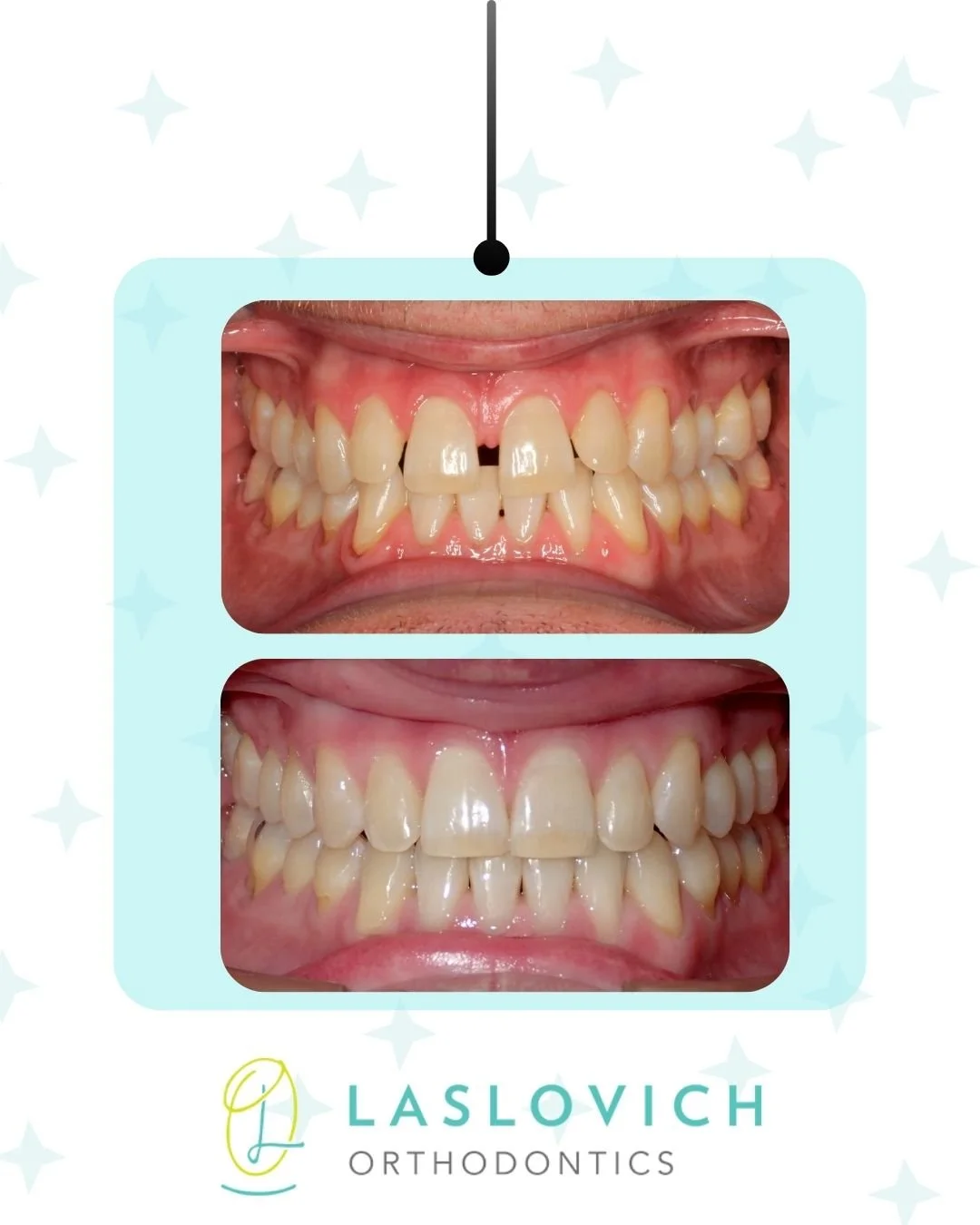 On the 8th day of Christmas, eight aligners aligning! Start your smile journey this New Year! 🦷
