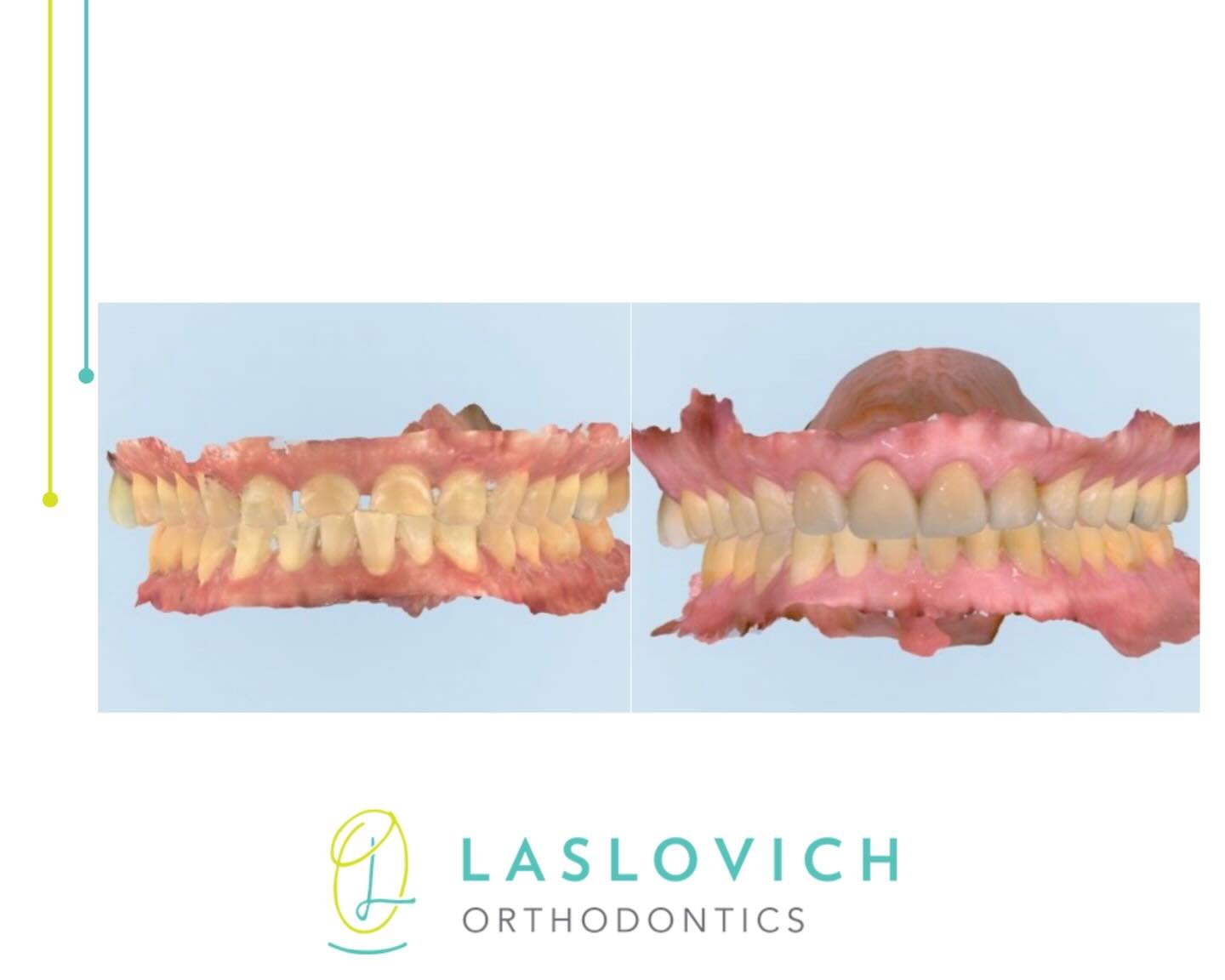 Transformation Tuesday! ✨
SWIPE TO SEE ALL BEFORE AND AFTER PHOTOS.

This adult patient came to us with concerns of:
&bull; deep bite
&bull; excessive wear
&bull; spacing upper, crowding lower 

With the completion of treatment, all of this patient c