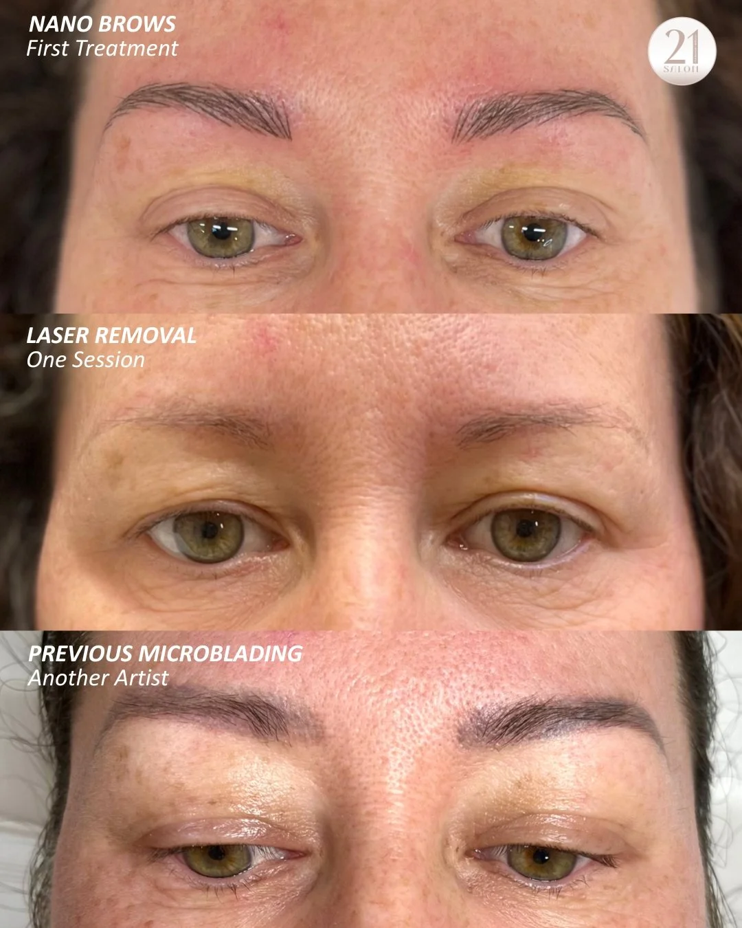 Brow journey's often start with a consultation. This lovely client wanted fresh beautiful nano brows, however with advice chose to start with a clear canvas and opted for tattoo laser removal and the final result shows it was the perfect choice #lase