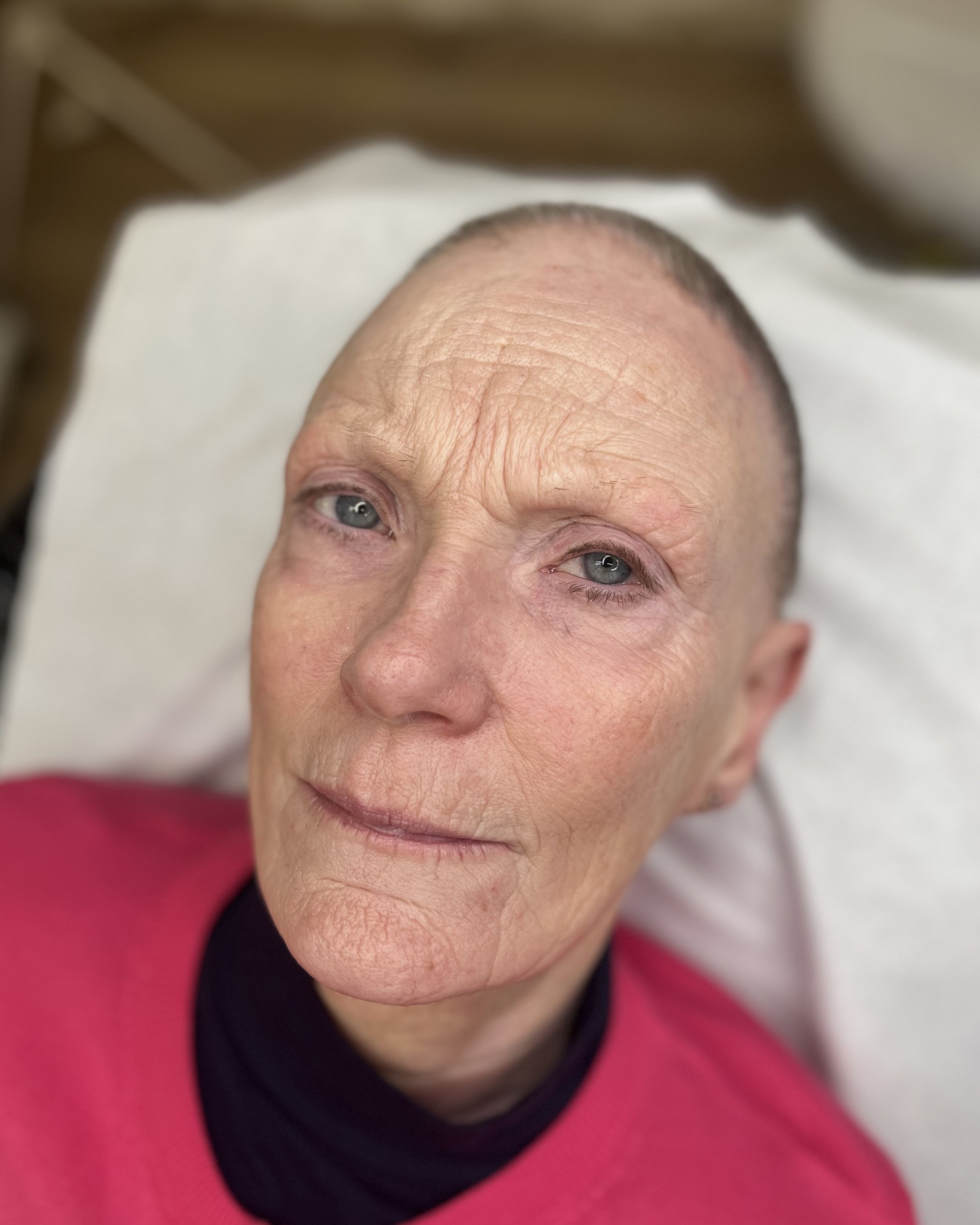 Before side shot of my beautiful clients sparse brows after suffering with Alopecia for years #alopecia #hairstroke #brows  
