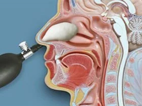 Image of Nasal Release Technique being performed and anatomically what it would look like as the balloon is inserted in between the turbinates and adjusting the deeper cranial bones