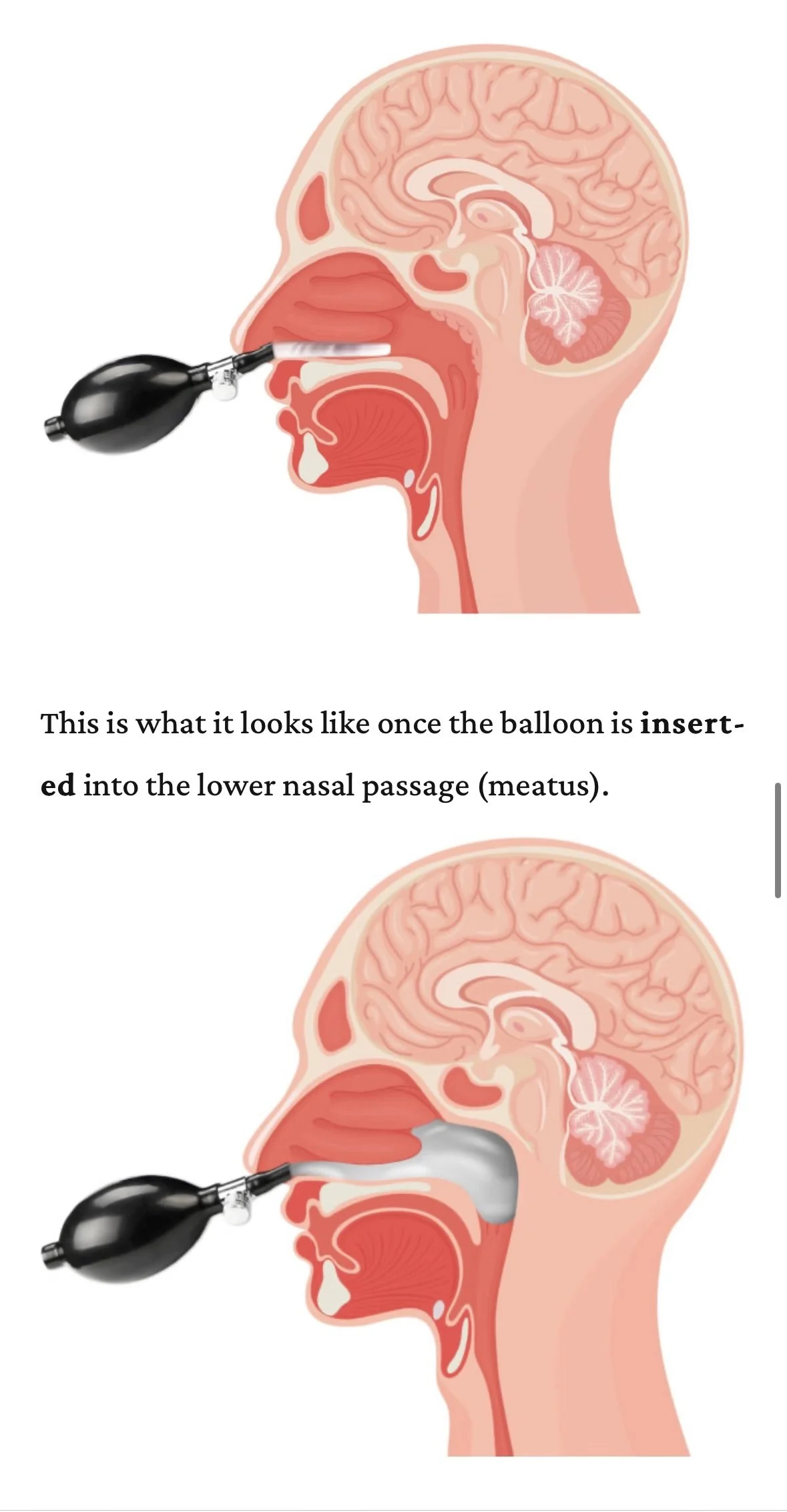 An lateral view of the anatomy of the nasal passages and where the balloon is placed during nasal ballooning therapy