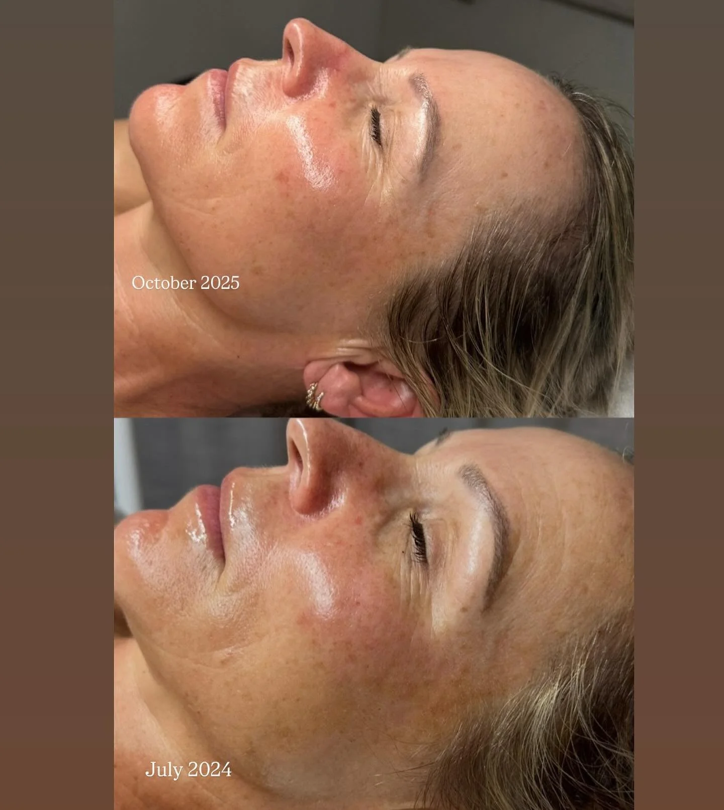 ✨ Pigment + Ageing Progress ✨

We&rsquo;ve been working on reducing pigmentation, fine lines, and wrinkles for our beautiful client &mdash; using targeted Lira Clinical peels and a personalised homecare plan.

Her skin is glowing with:
💫 Brighter, m