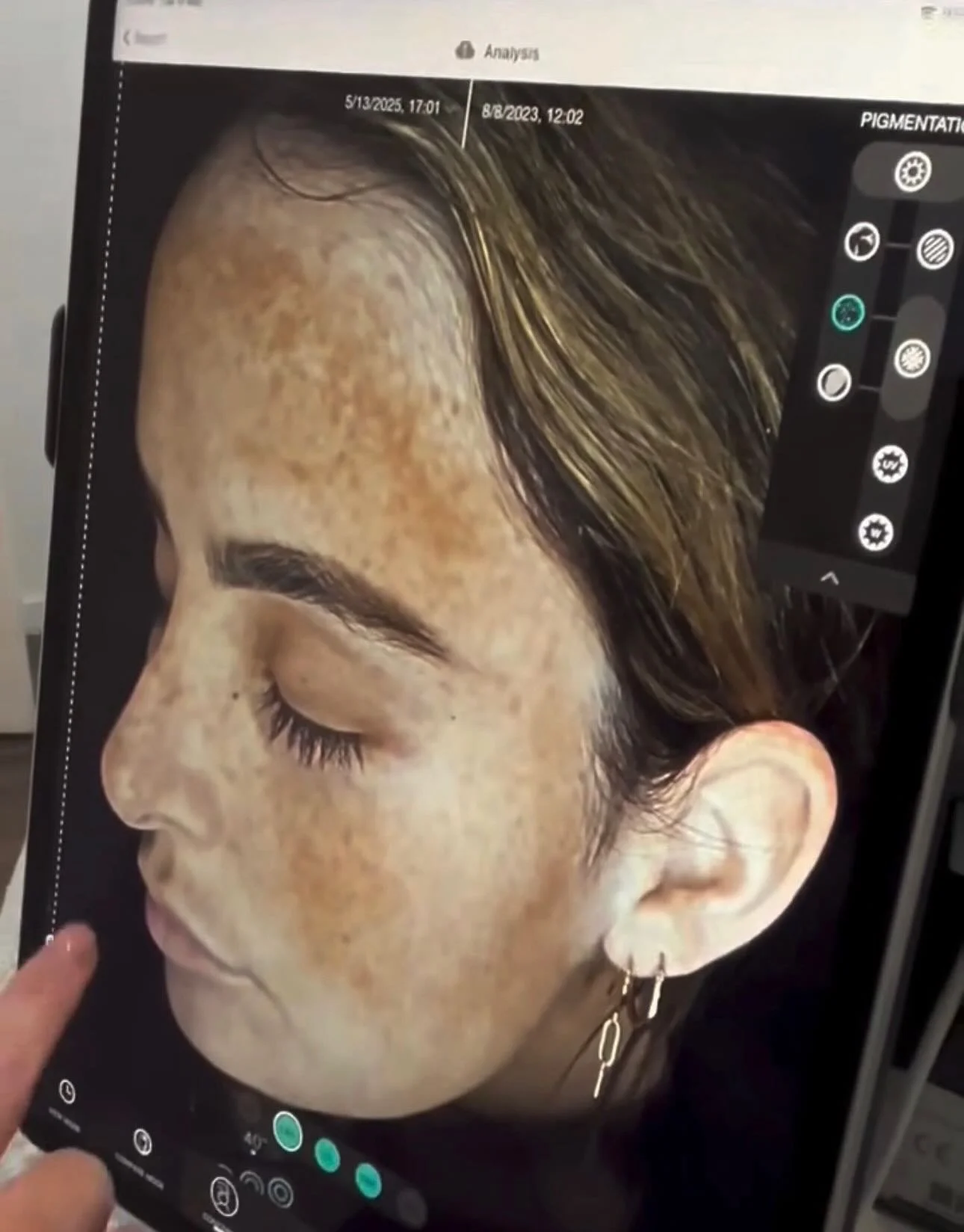 Before &amp; After ✨

Ella&rsquo;s skin journey using professional @liraclinical Clinical skincare and tailored in-salon treatments has completely transformed her complexion &mdash; healthier barrier, smoother texture, brighter, calmer skin!

Consist