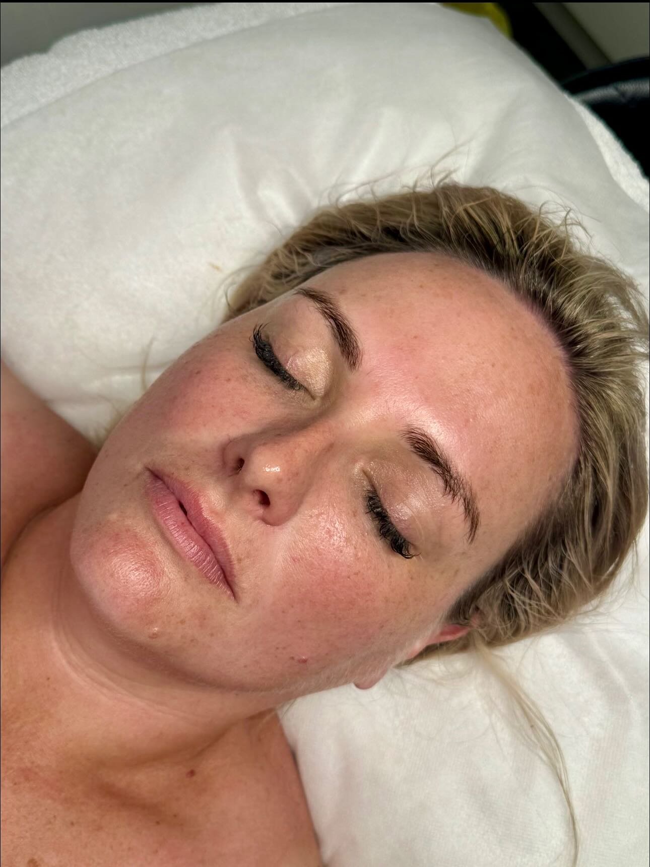 From reactive + inflamed&hellip; to calm, strong + glowing 

This beautiful client originally came to us with extremely sensitive skin, constant histamine-style flare-ups, and a very compromised barrier. She couldn&rsquo;t tolerate most products, and