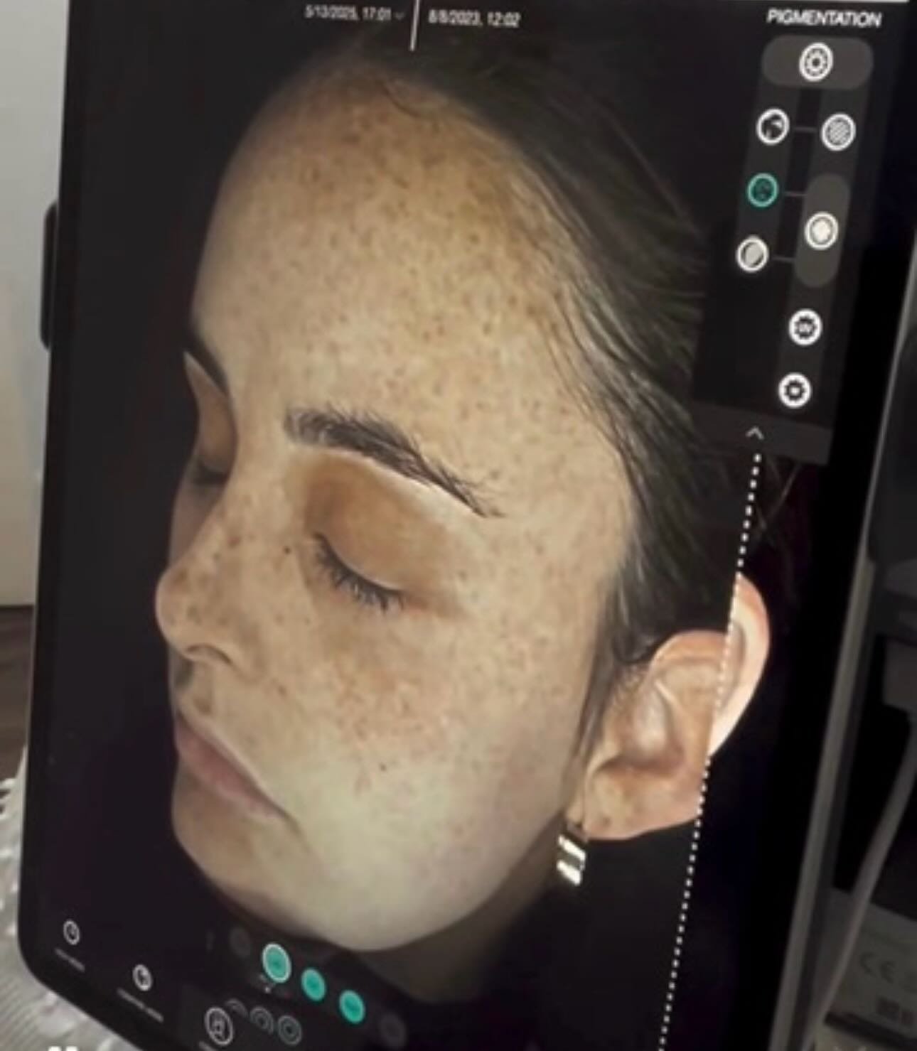 PIGMENTATION TRANSFORMATION 
Real results using Lira clinical 

Swipe to see this incredible pigmentation change we&rsquo;ve been able to achieve.

Pigmentation isn&rsquo;t always visible on the surface &mdash; devices like this allow us to see under