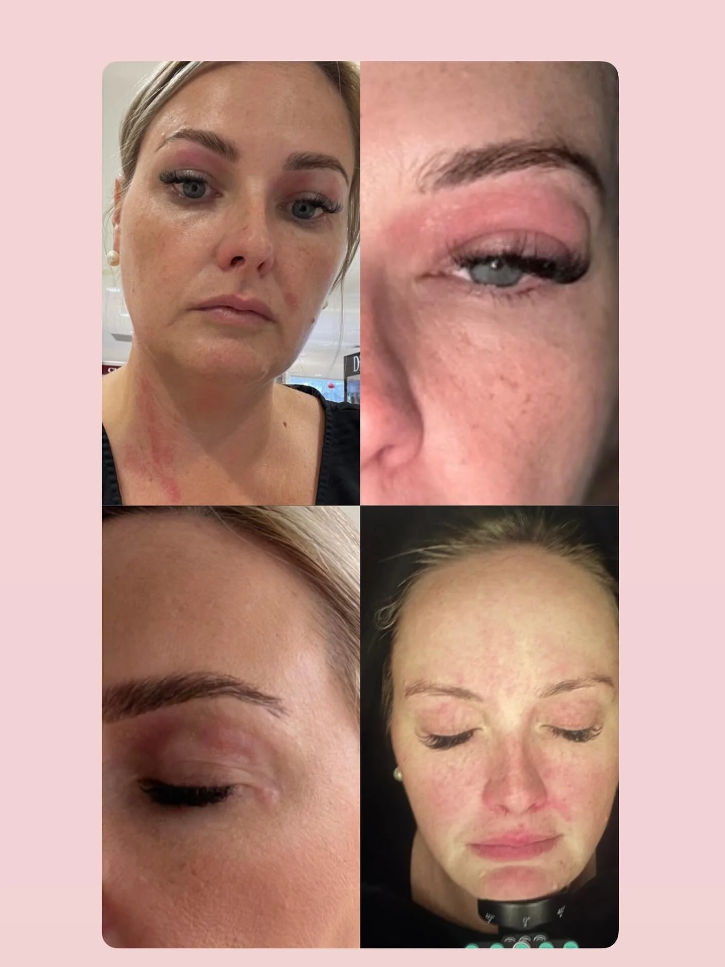 Healthy skin isn&rsquo;t about doing more it&rsquo;s about healing first.

This skin experienced a histamine response alongside a severely compromised skin barrier.

When the barrier is damaged, the skin becomes reactive, inflamed, and prone to flare