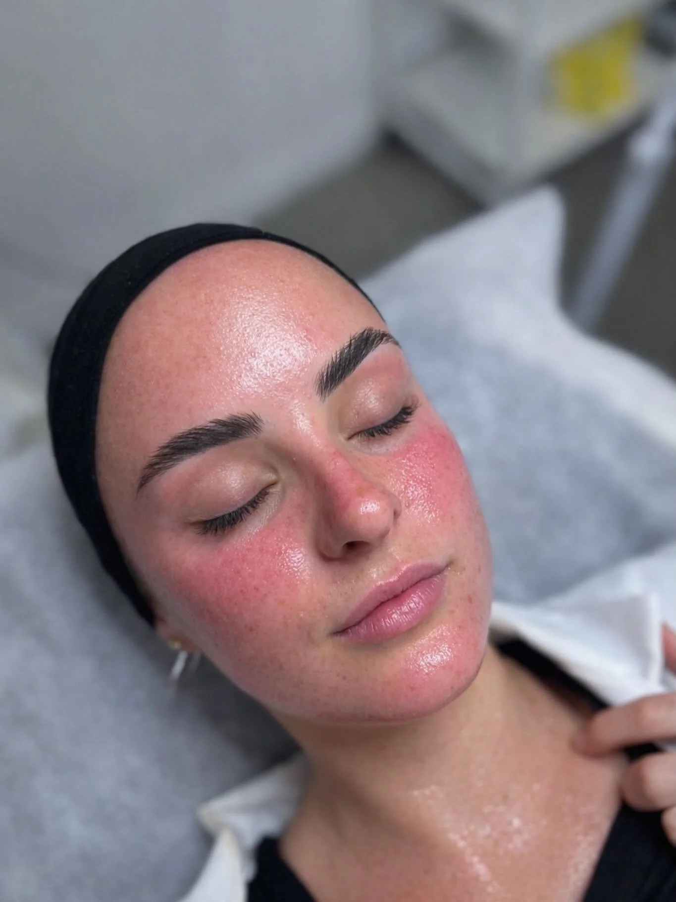 The Power of Skin Needling 

This is what fresh collagen stimulation looks like.

&bull; Increased blood flow
&bull; Immediate skin plump
&bull; Accelerated cell renewal
&bull; Stimulated collagen + elastin production
&bull; Improved texture + scarri