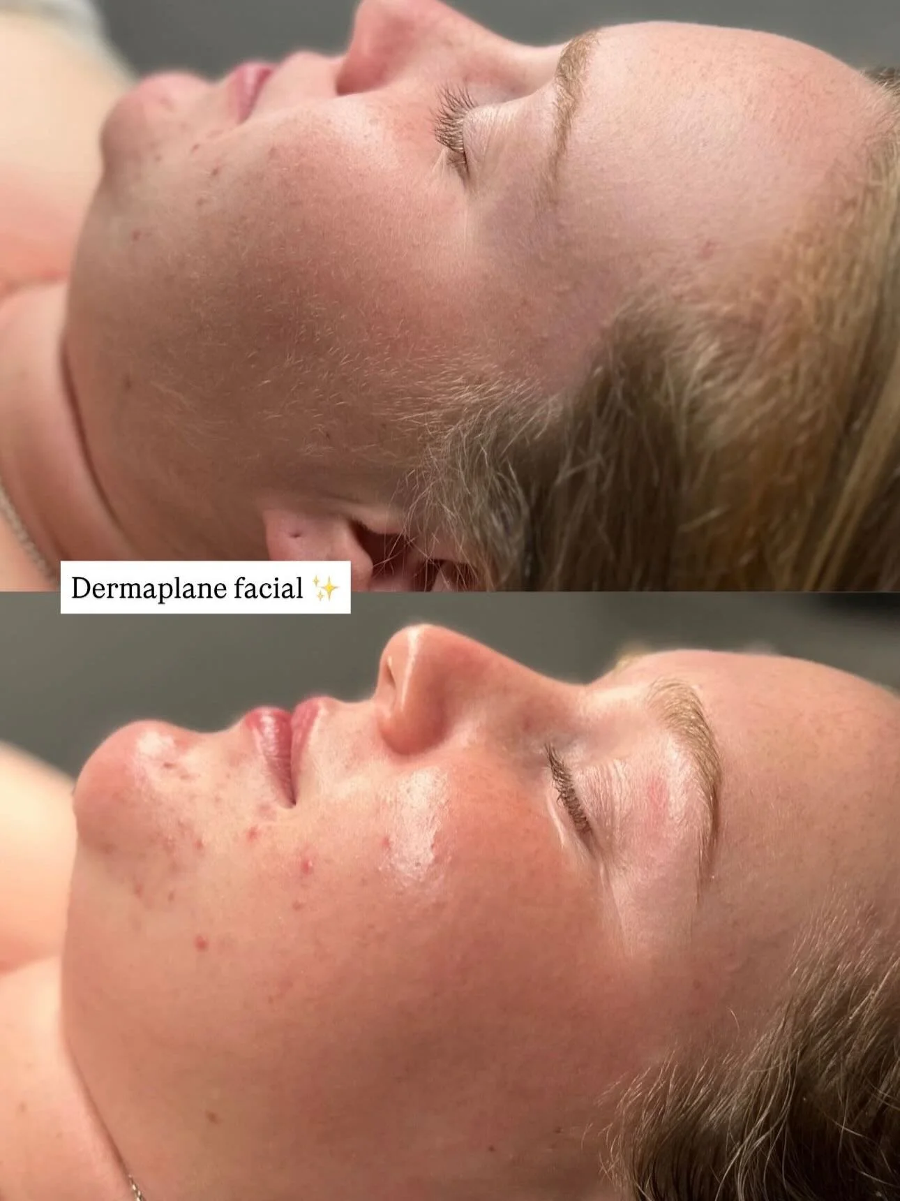 Dermaplaning is the ultimate skin reset removing 
dead skin + peach fuzz to instantly reveal a brighter, smoother complexion.

Think:
✨ Better product absorption
✨ Flawless makeup application
✨ Softer, more even skin
✨ Instant glow

Perfect before an