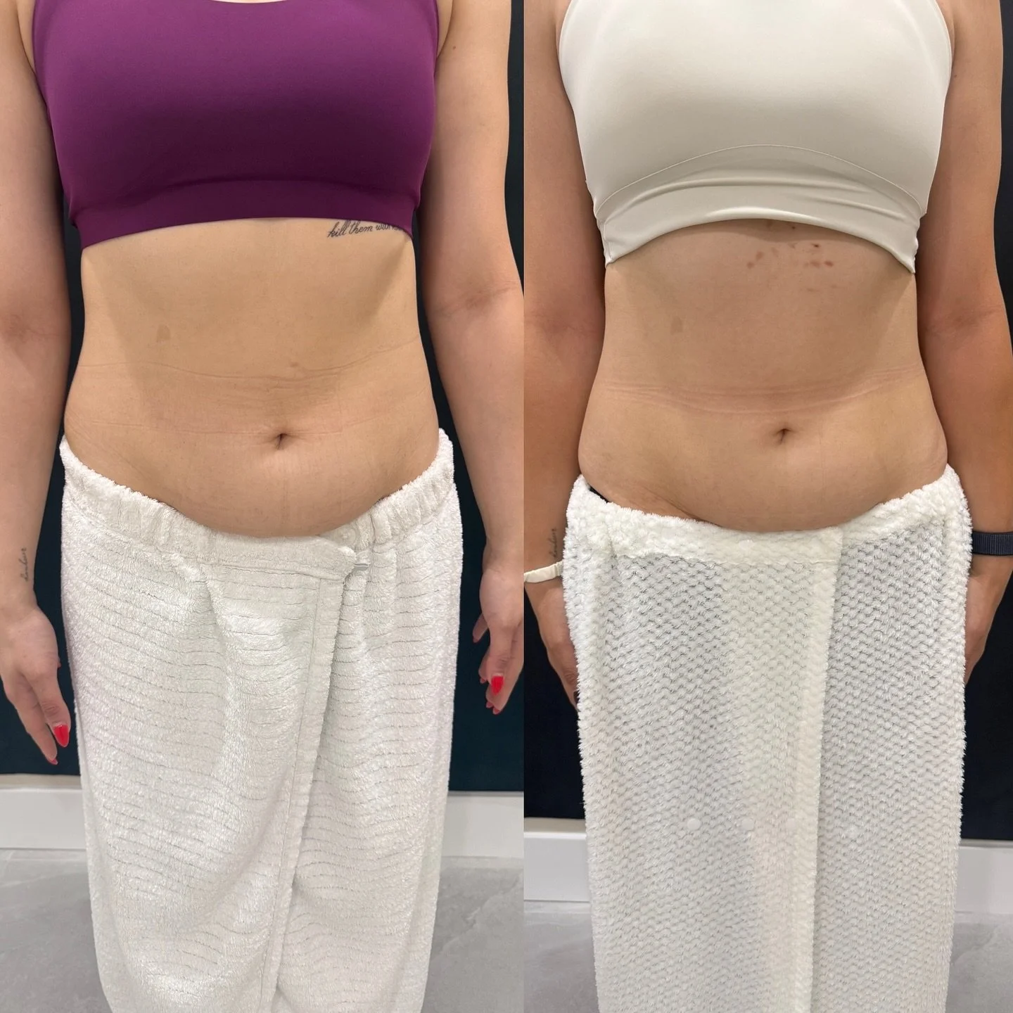 Evolve Results- It Truly Speaks For Itself ✨

Belly 34inches down to 28inches (a total of 6 inches)
Lower Belly 36.5 inches down to 29inches (a total of 7.5 inches)
*a committed member of 4 months*

#evolvex #medspa #1faceskinclinic #bodycontouring #