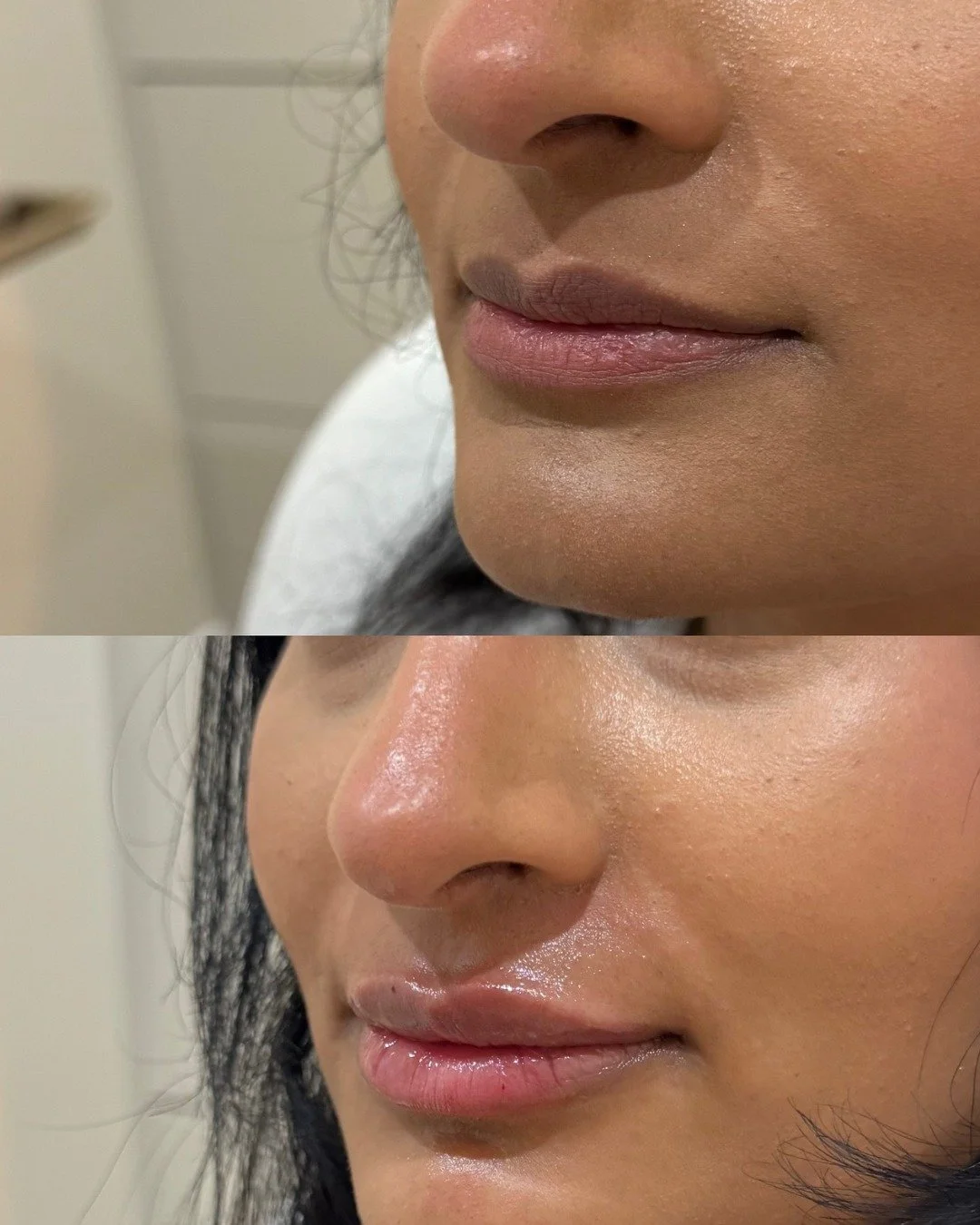 Recent Mini Lip Plumps 👄💕 swipe to see before &amp; after

#skinclinic #liptransformation #lipfiller #beforeandafter #1faceskinclinic