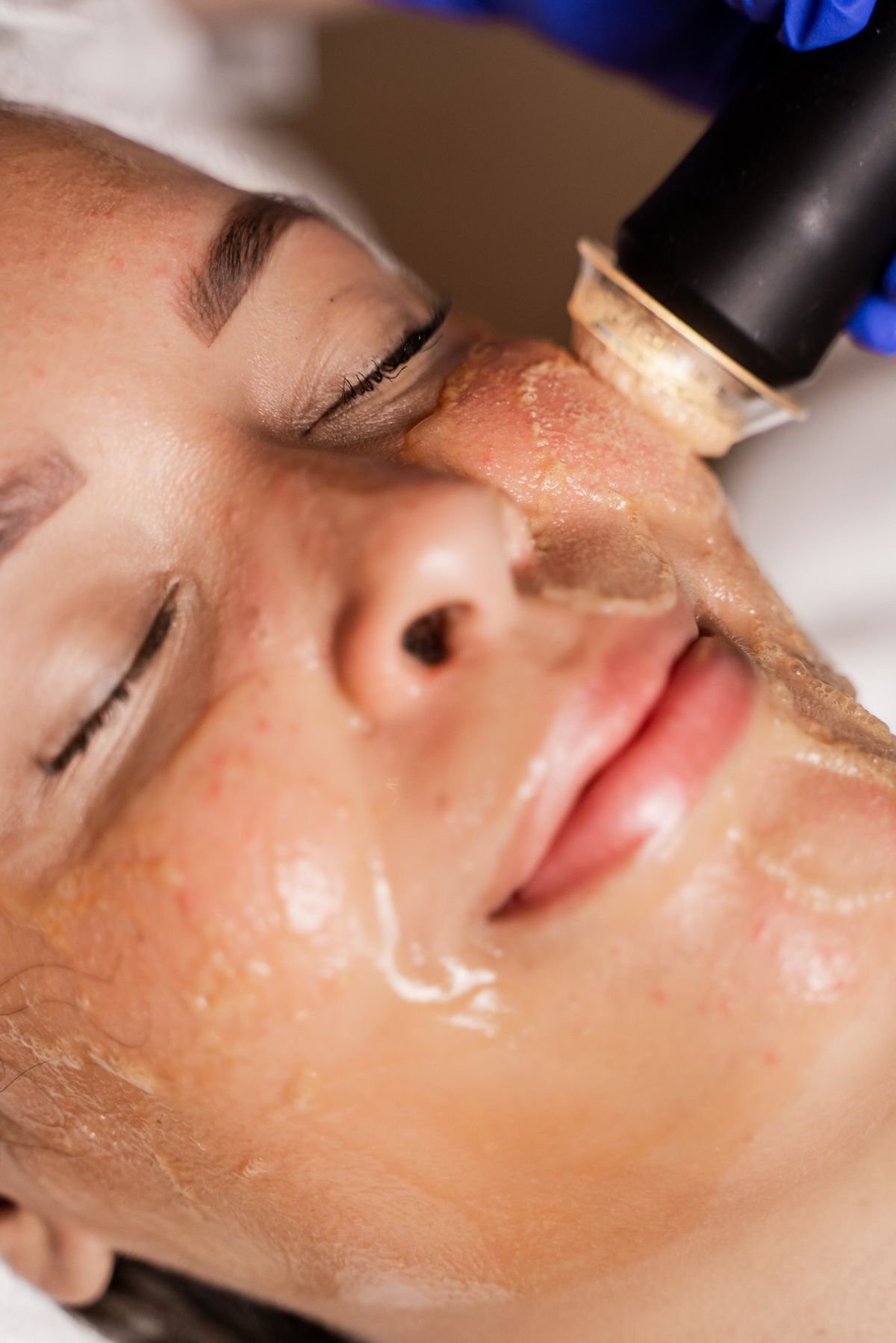 Top 5 Skin Concerns Lasers Can Treat