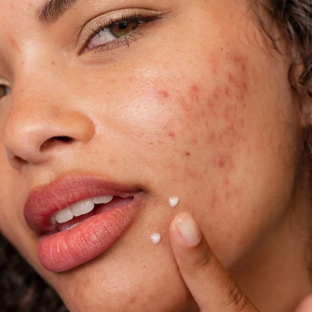 Hormonal Acne in Adults: Why It’s Different and How to Treat It