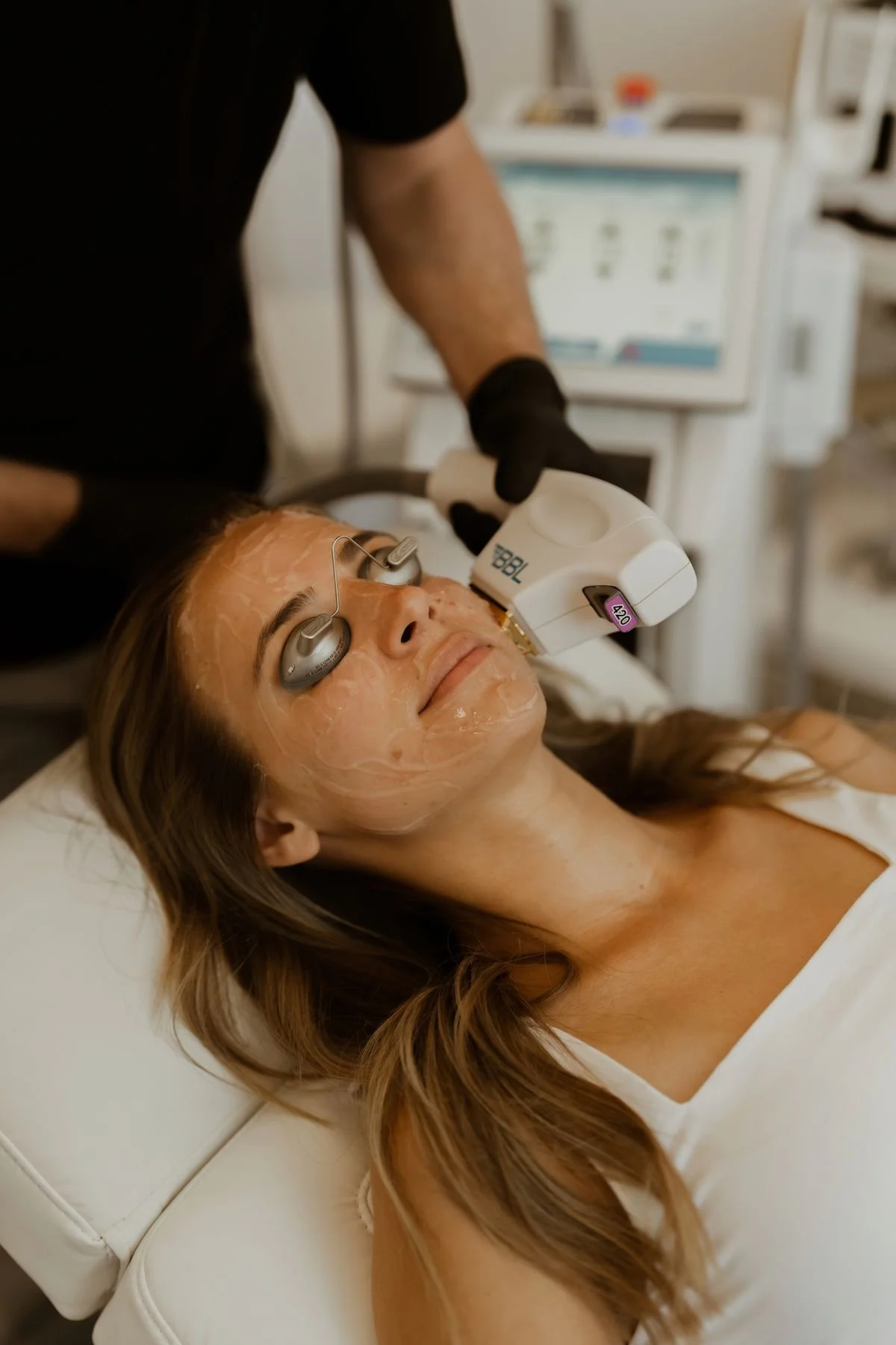 Lumecca IPL for Rosacea and Redness Reduction