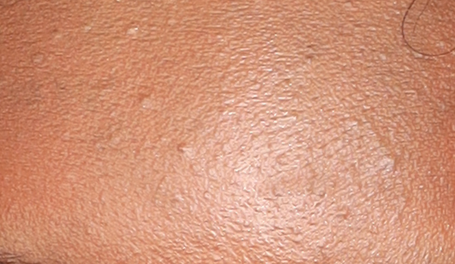 Close-up of a person's skin with visible pores and a few fine hairs.
