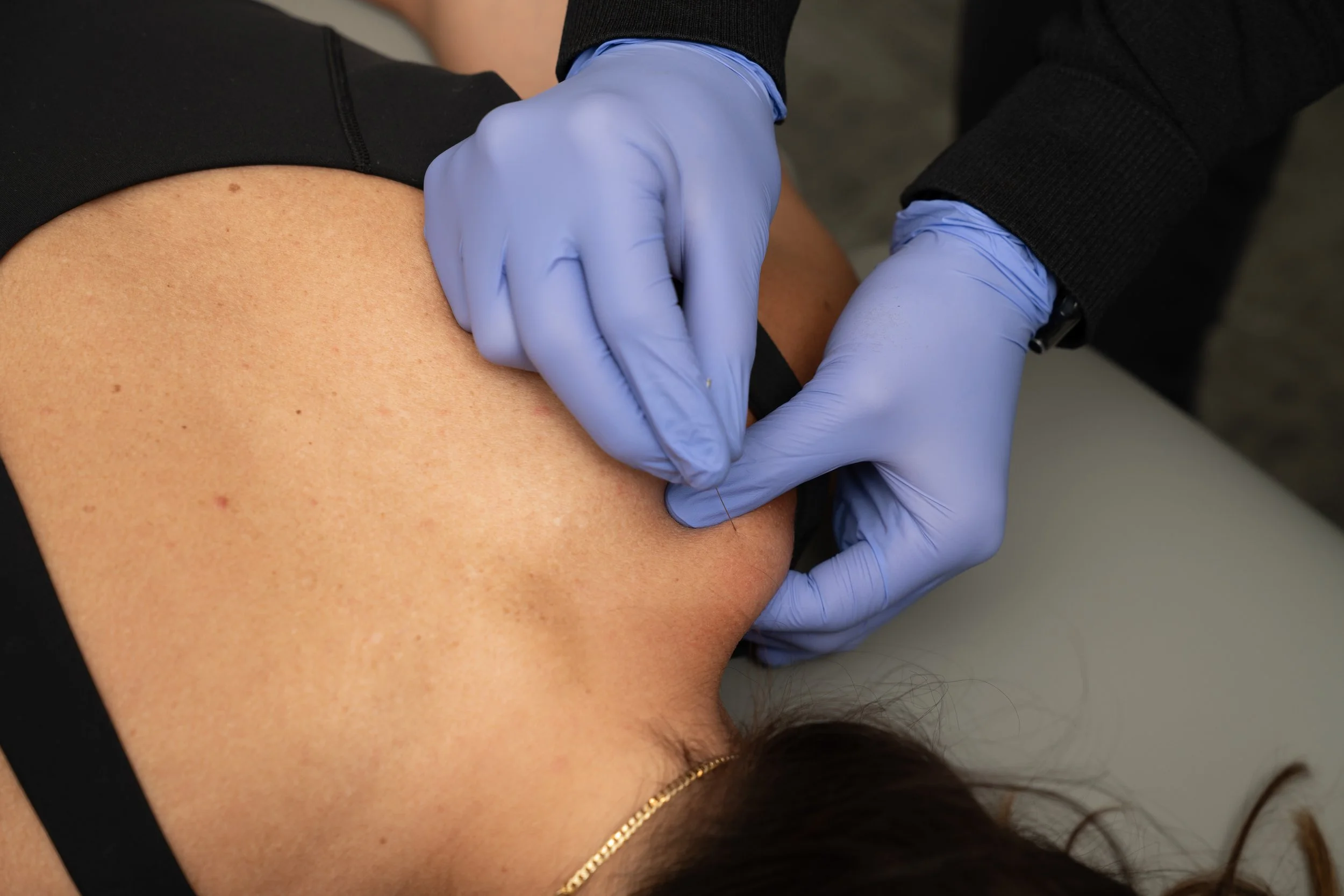 Dry Needling or Massage Therapy in Tsawwassen : Which is Better for Muscle Tension?