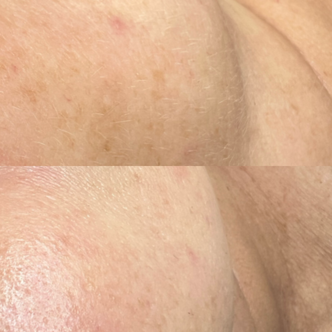 Before and after comparison of skin treated with DMK Alkaline Wash