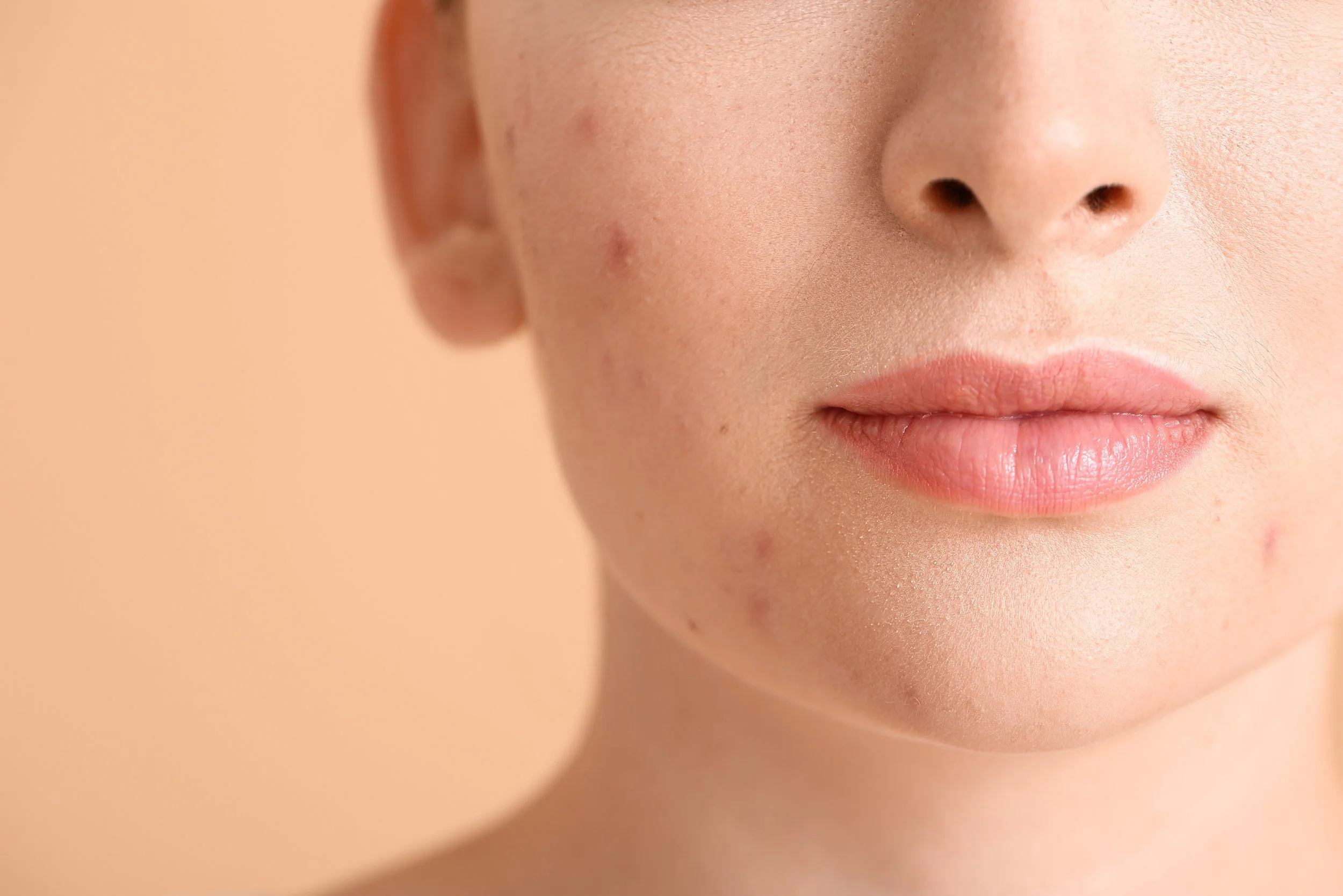Pimples.