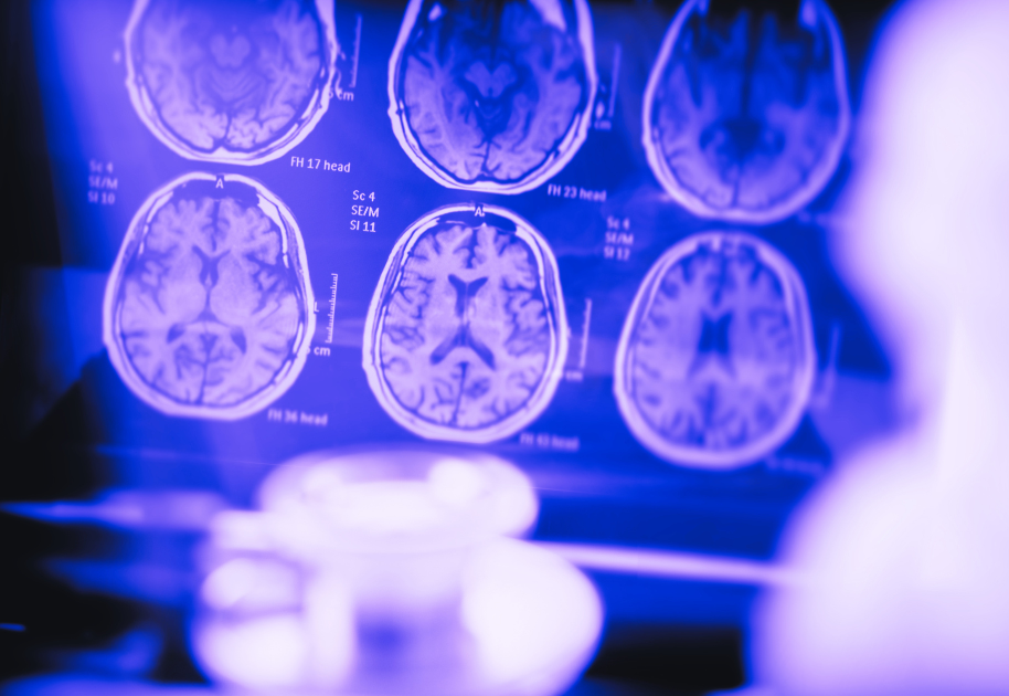 Could Creatine Monohydrate be a Potential Disease-Modifying Therapy in Alzheimer’s?