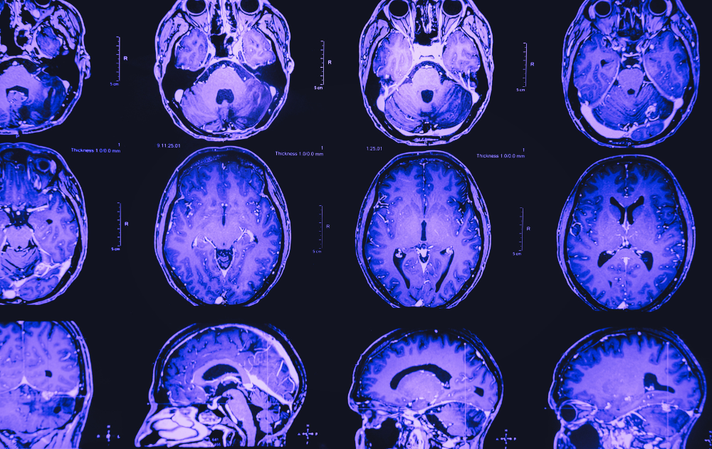 Creatine and Mental Health: Mechanisms, Clinical Evidence, and Emerging Therapeutic Potential