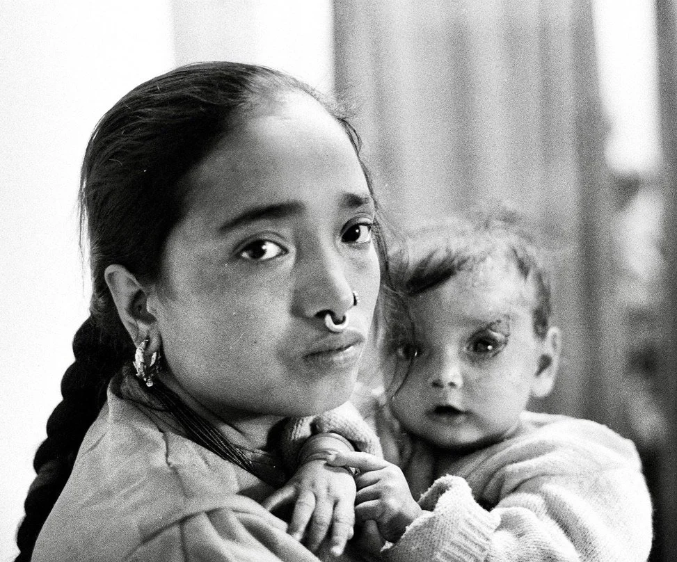 split skin graft for burn scarring