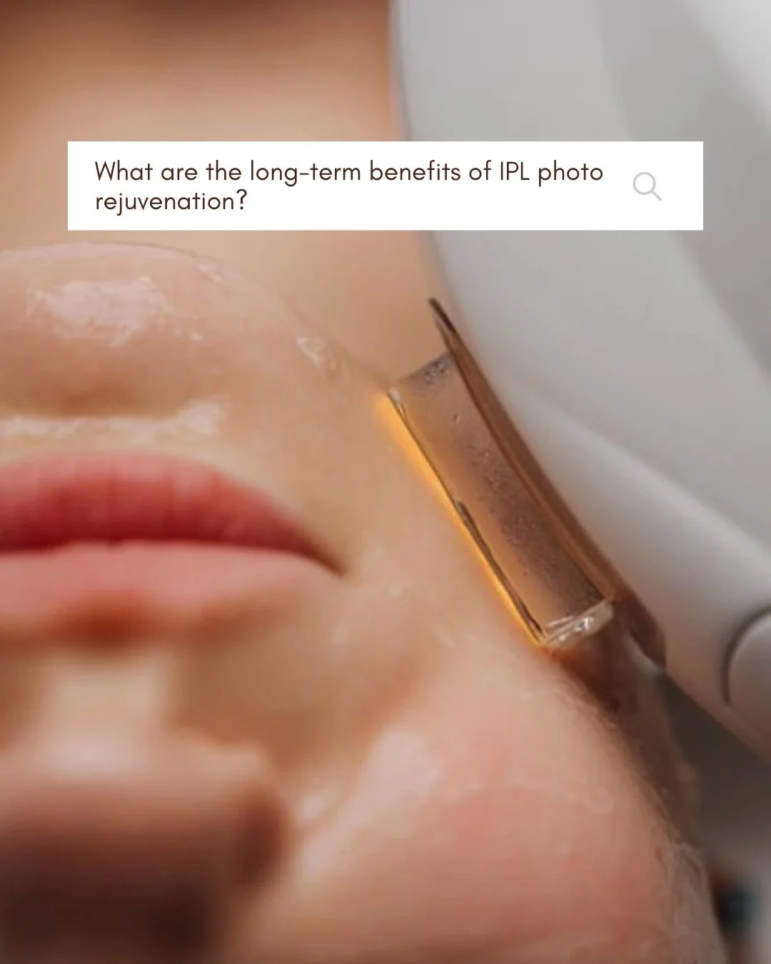 IPL isn&rsquo;t just a quick solution. It&rsquo;s a long-term skin investment. Clearer, brighter, more even skin, with ongoing collagen support and visible improvement over time. Consistency is key.

Book today!