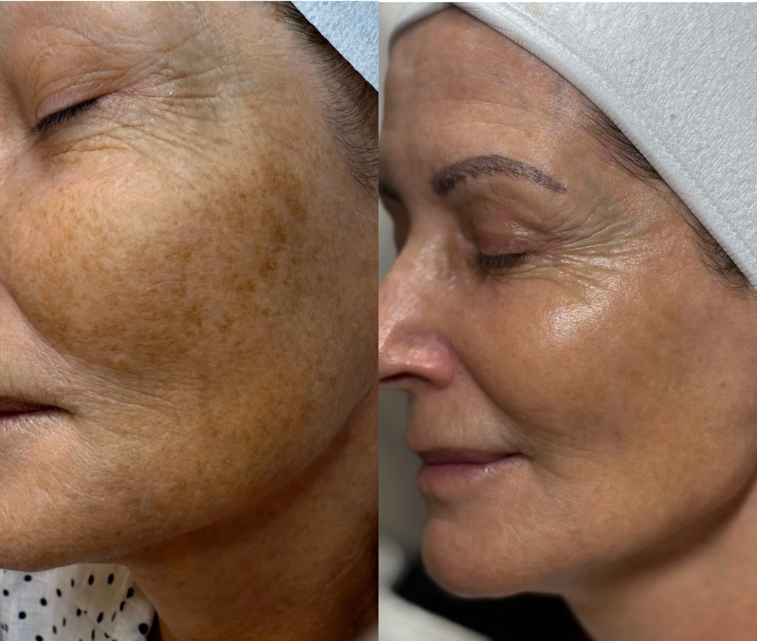 One treatment of IPL Skin Rejuvenation + Pigment ~ 

Brighter, clearer &amp; more even skin after just ONE session 🤍
.
.
.
.
.
#ipl #beforeandafter #skin #skinandclaylennox #results