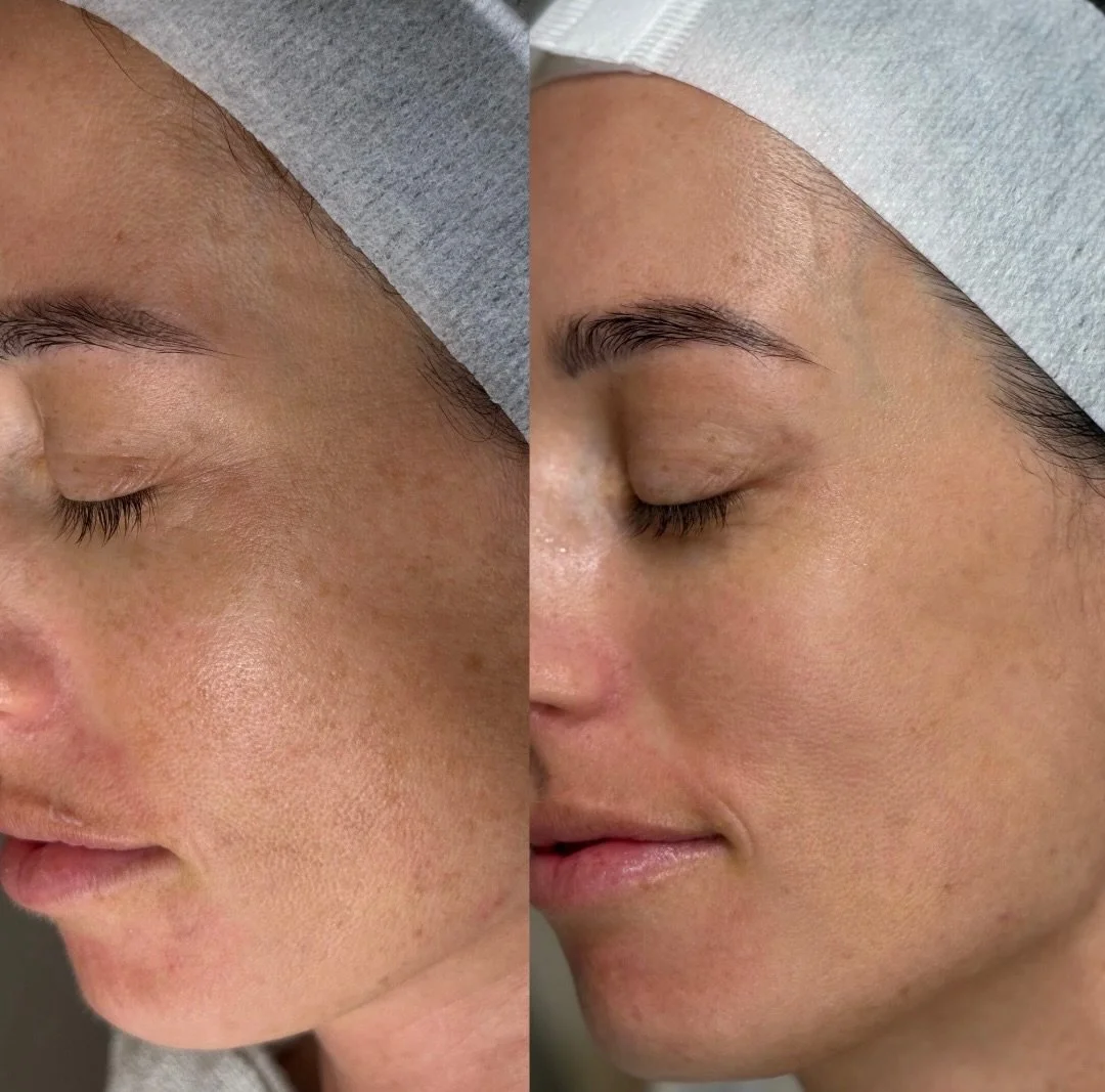 Another before &amp; after from our IPL Pigmentation Treatment. ✨

Brighter, clearer, more even skin. 🤎
.
.
.
#ipl #pigment #skin #lennoxhead #skinandclay