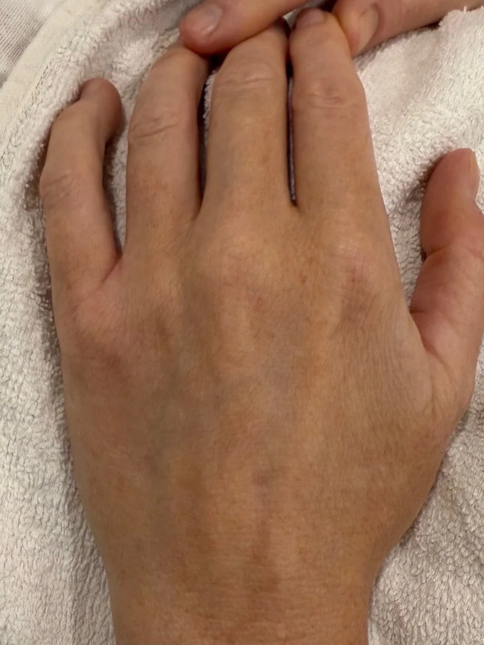 Proof is in the before &amp; after. ✨🤍

Our IPL Hand Treatment works to reduce pigmentation, sun spots and signs of ageing, leaving your hands looking fresher and more youthful.
.
.

.
#ipl #hands #skinandclay #lennoxhead #skin