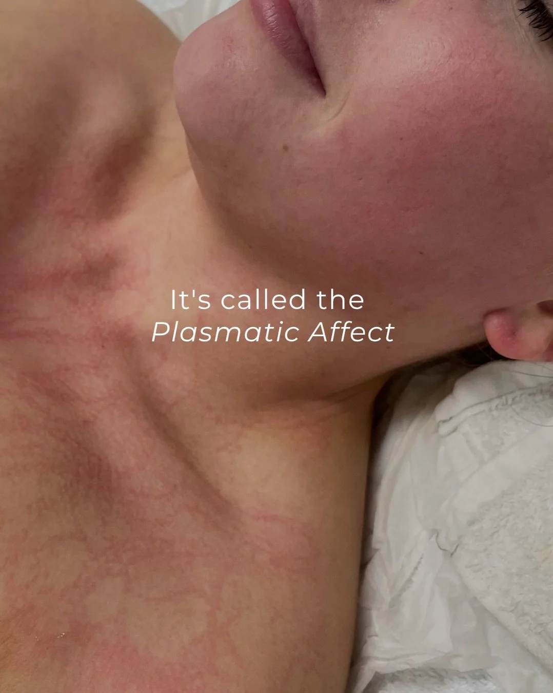 That flushed, veiny look straight after DMK Enzyme Therapy isn&rsquo;t a reaction &mdash; it&rsquo;s the plasmatic effect, and it&rsquo;s the part we get excited about
Swipe to see what&rsquo;s going on under the surface.
#plasmaticeffect #dmkenzymet