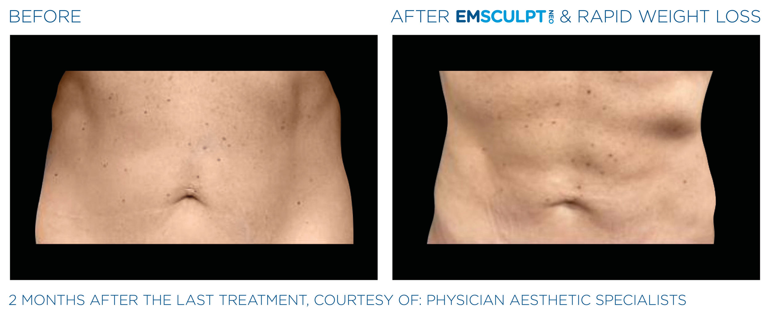 Comparison of a person's abdomen before and after EMsculpt Neo and rapid weight loss treatment, showing a reduction in body fat two months after the last treatment.