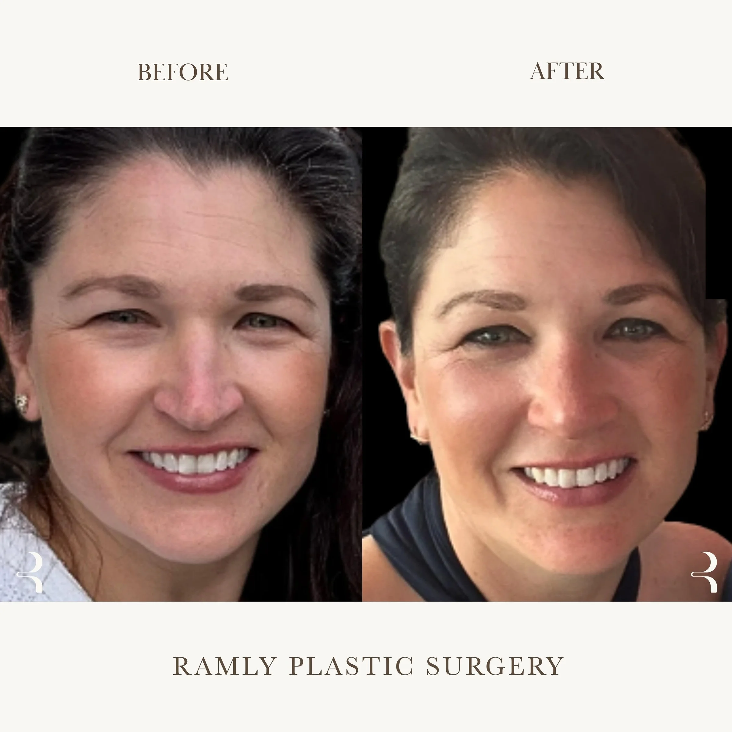 Rhinoplasty before and after by Dr. Elie Ramly in Beverly Hills showing natural feminine dorsal aesthetic lines and proportions with refined nasal tip and improved balance.