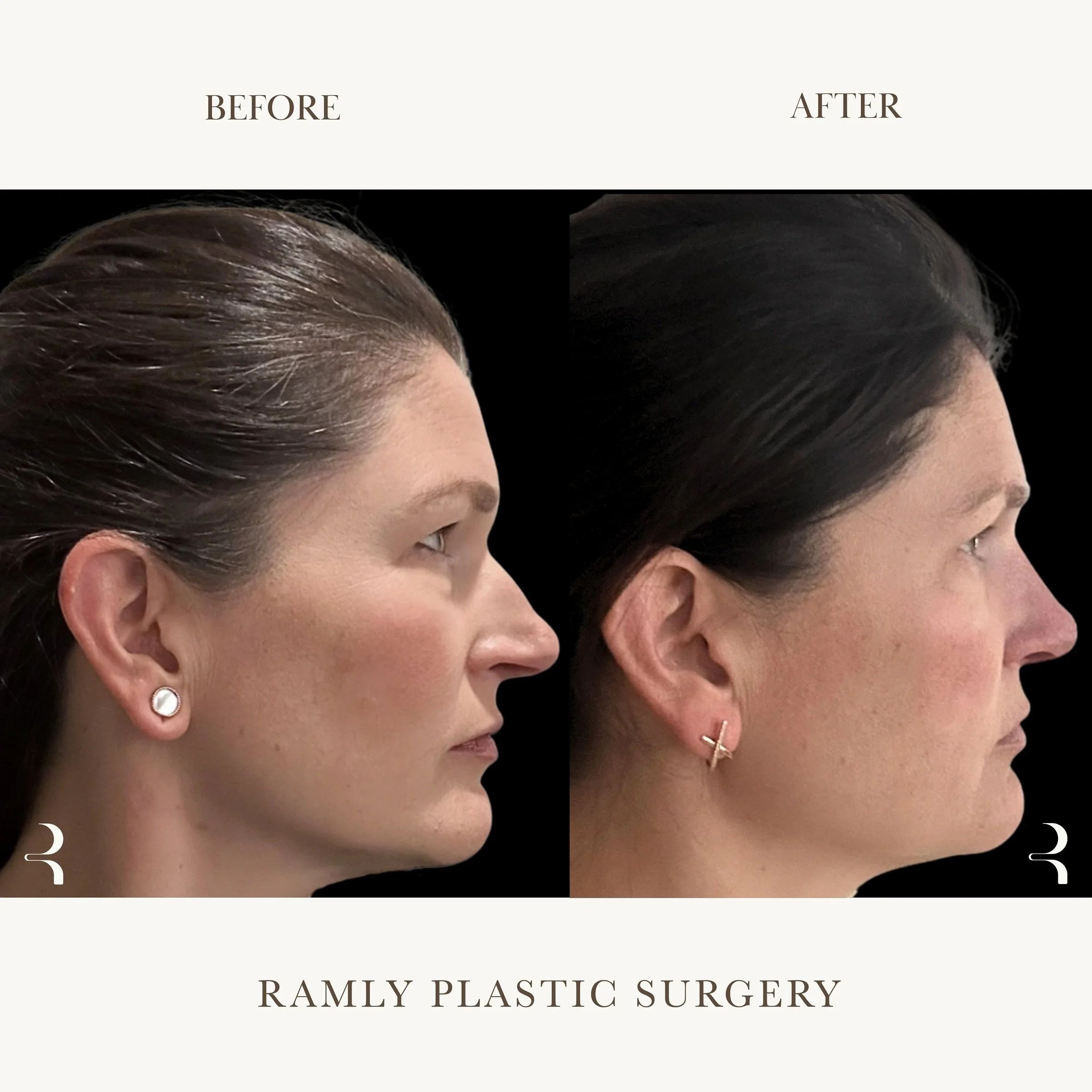 Rhinoplasty Beverly Hills | Natural Results | Dr. Elie Ramly
