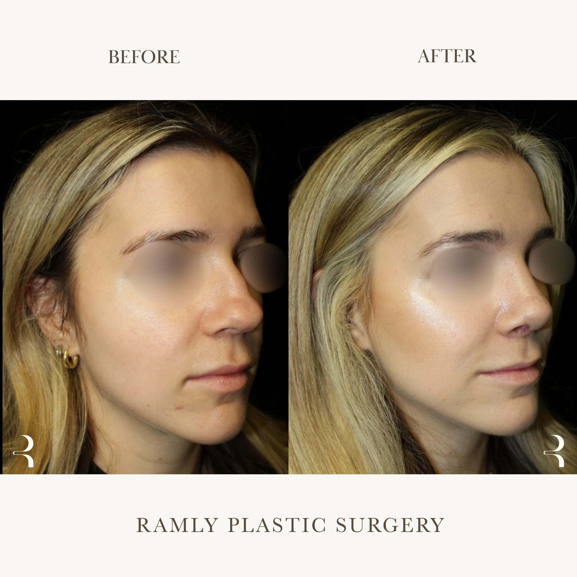 Revision Rhinoplasty Beverly Hills | Natural Results | Dr. Elie Ramly