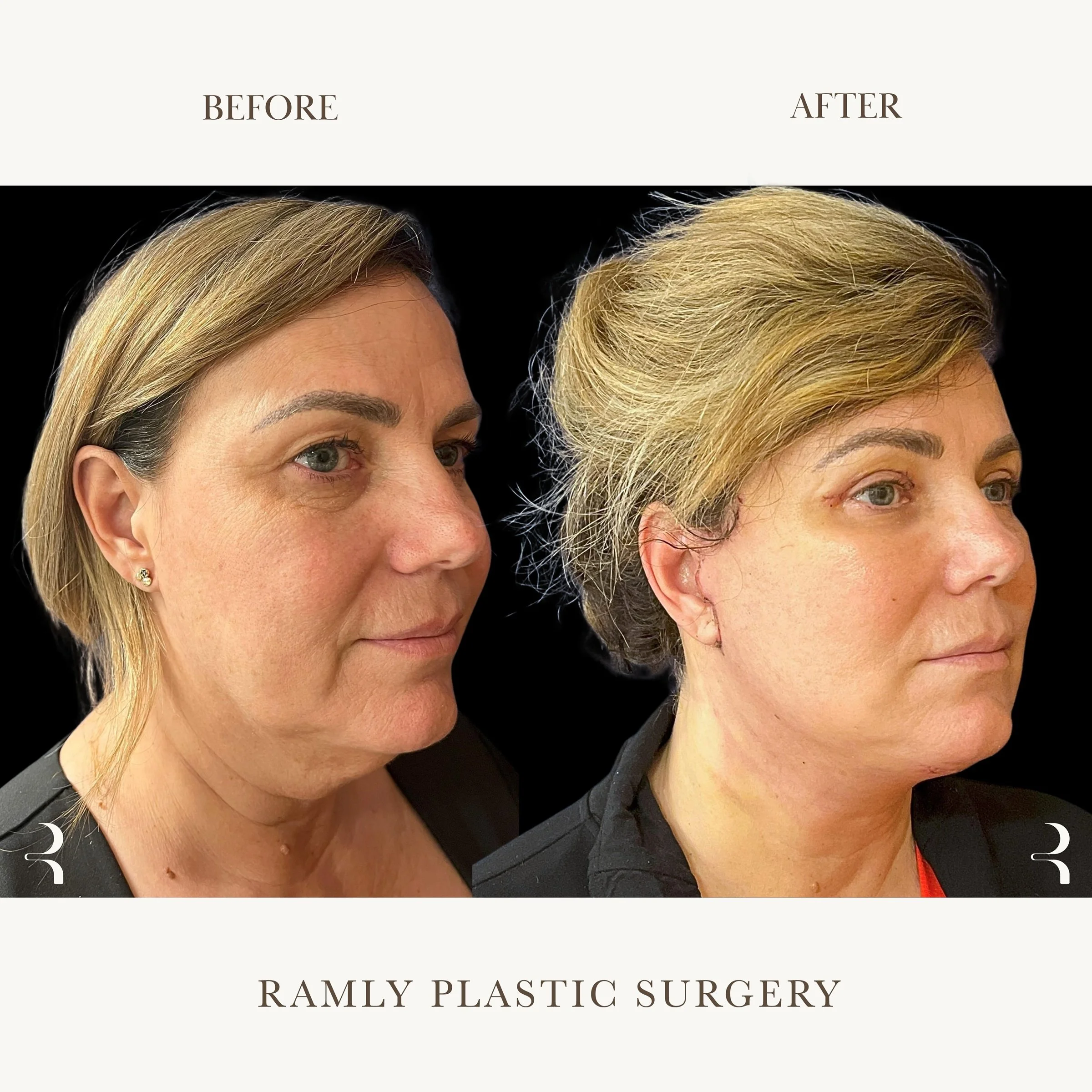Facelift and Neck Lift Beverly Hills | Natural Results | Dr. Elie Ramly