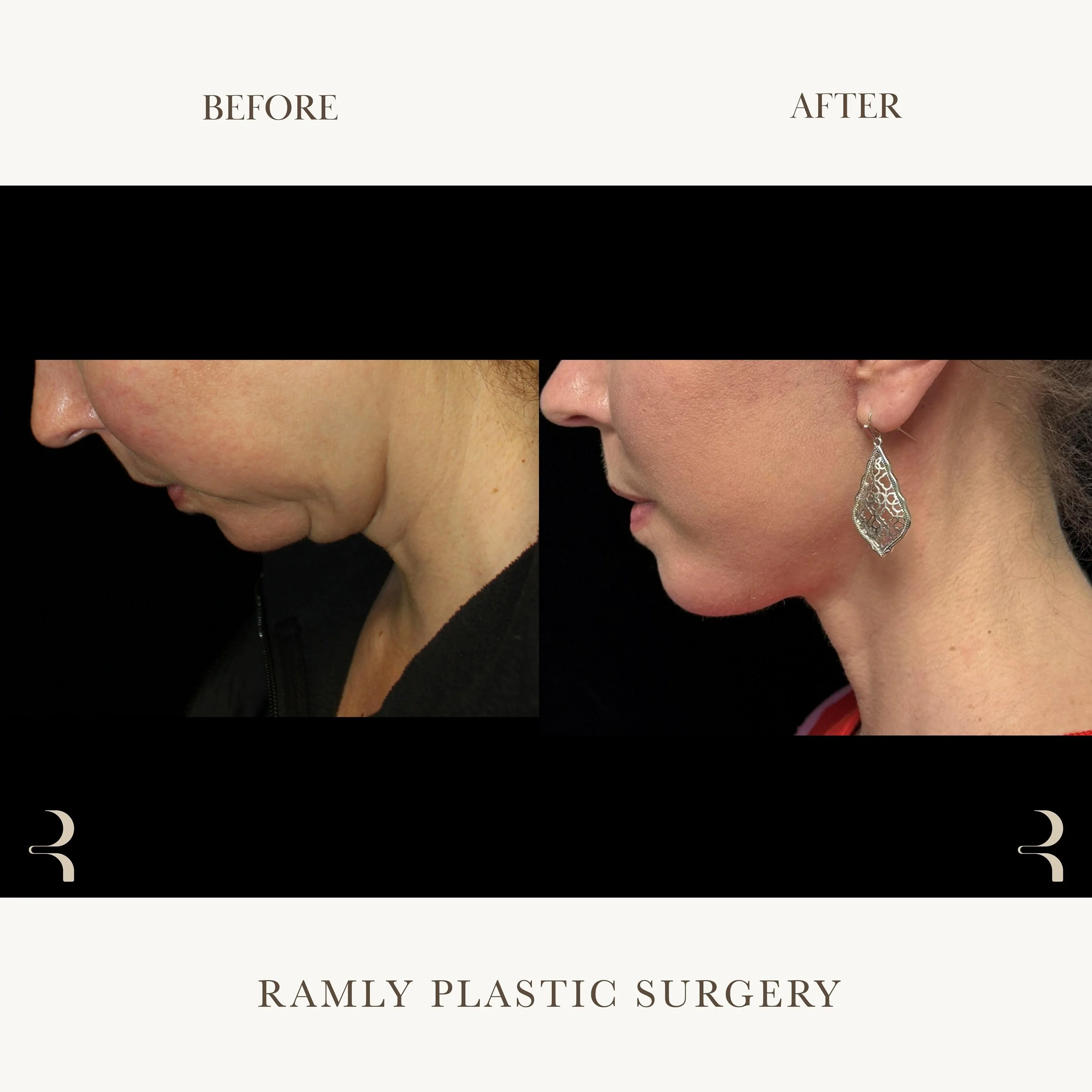 Facelift and neck lift before and after by Dr. Elie Ramly in Beverly Hills showing improved jawline definition and neck contour when looking down