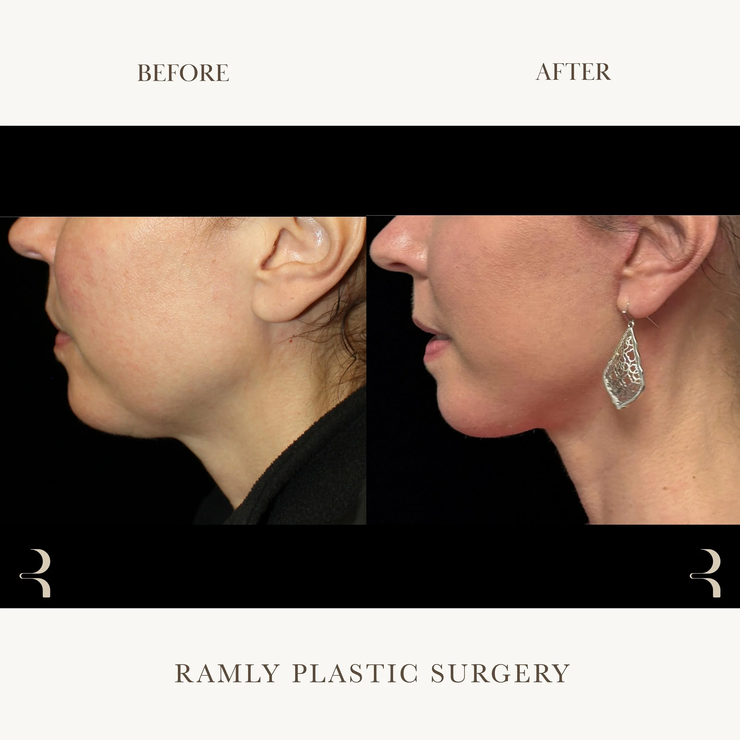 Facelift and neck lift before and after by Dr. Elie Ramly in Beverly Hills showing natural jawline definition and improved neck contour