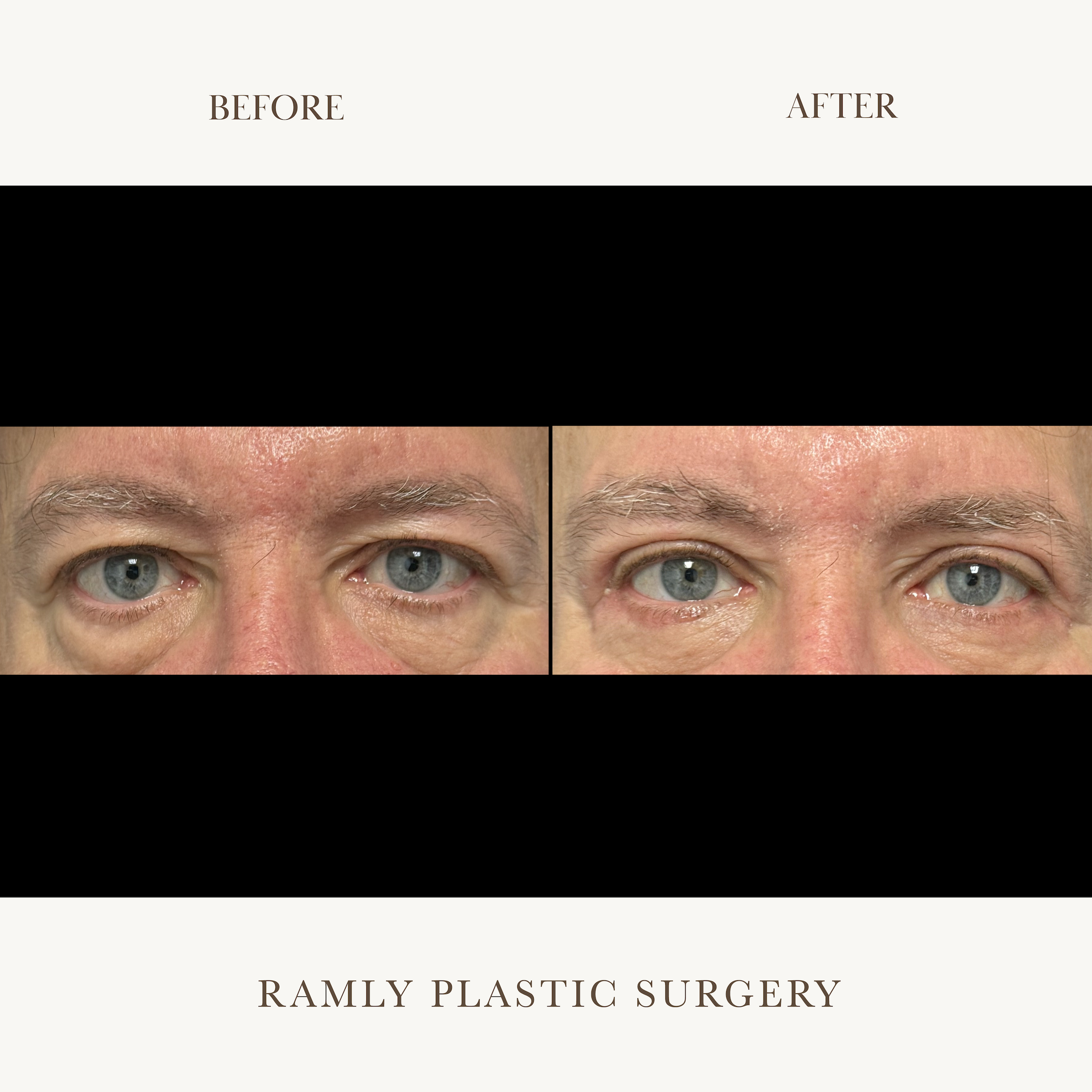 Male Blepharoplasty Beverly Hills | Upper & Lower Eyelid Surgery | Dr. Elie Ramly