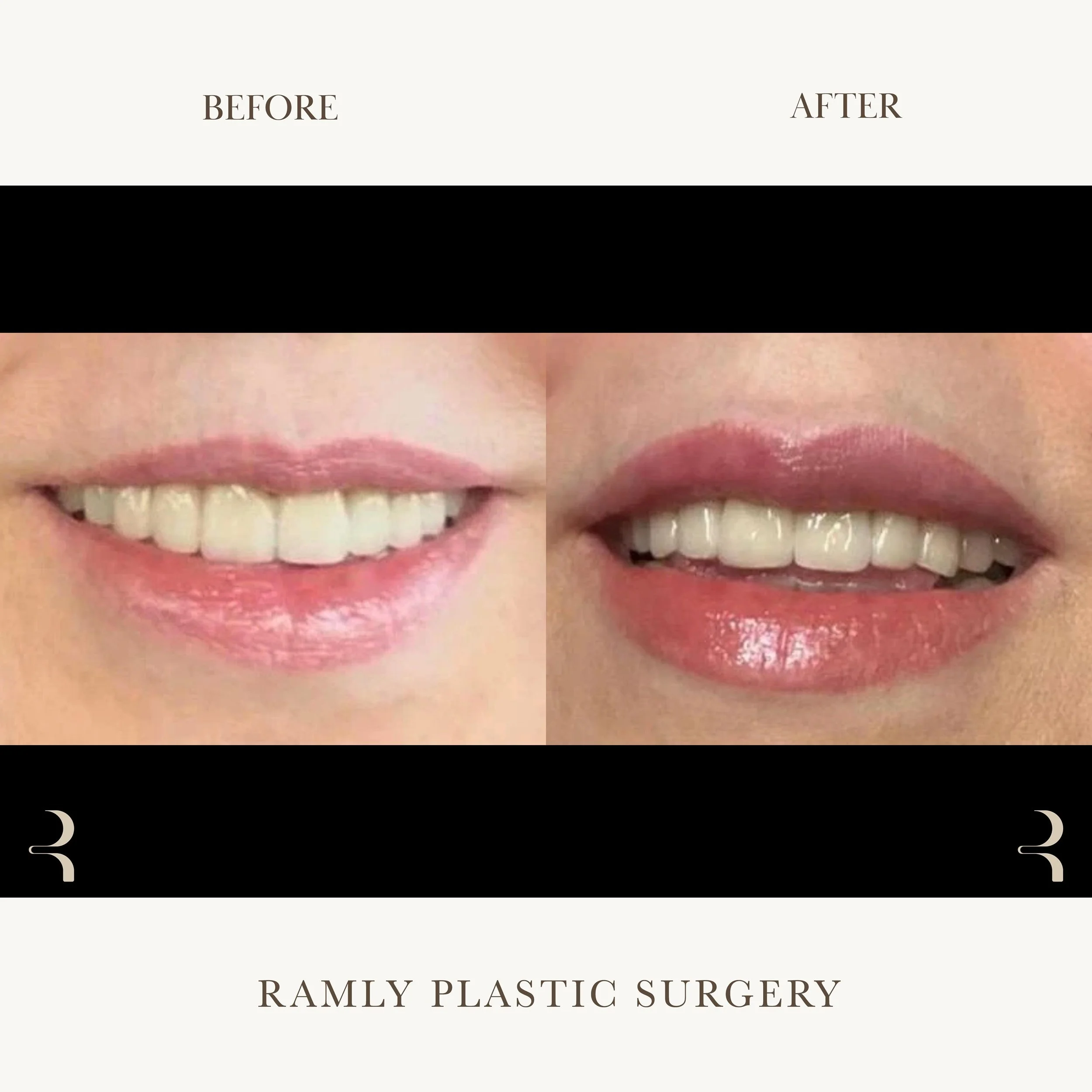 Lip filler before and after by Dr. Elie Ramly in Beverly Hills showing natural lip enhancement with subtle volume, refined shape, and improved definition
