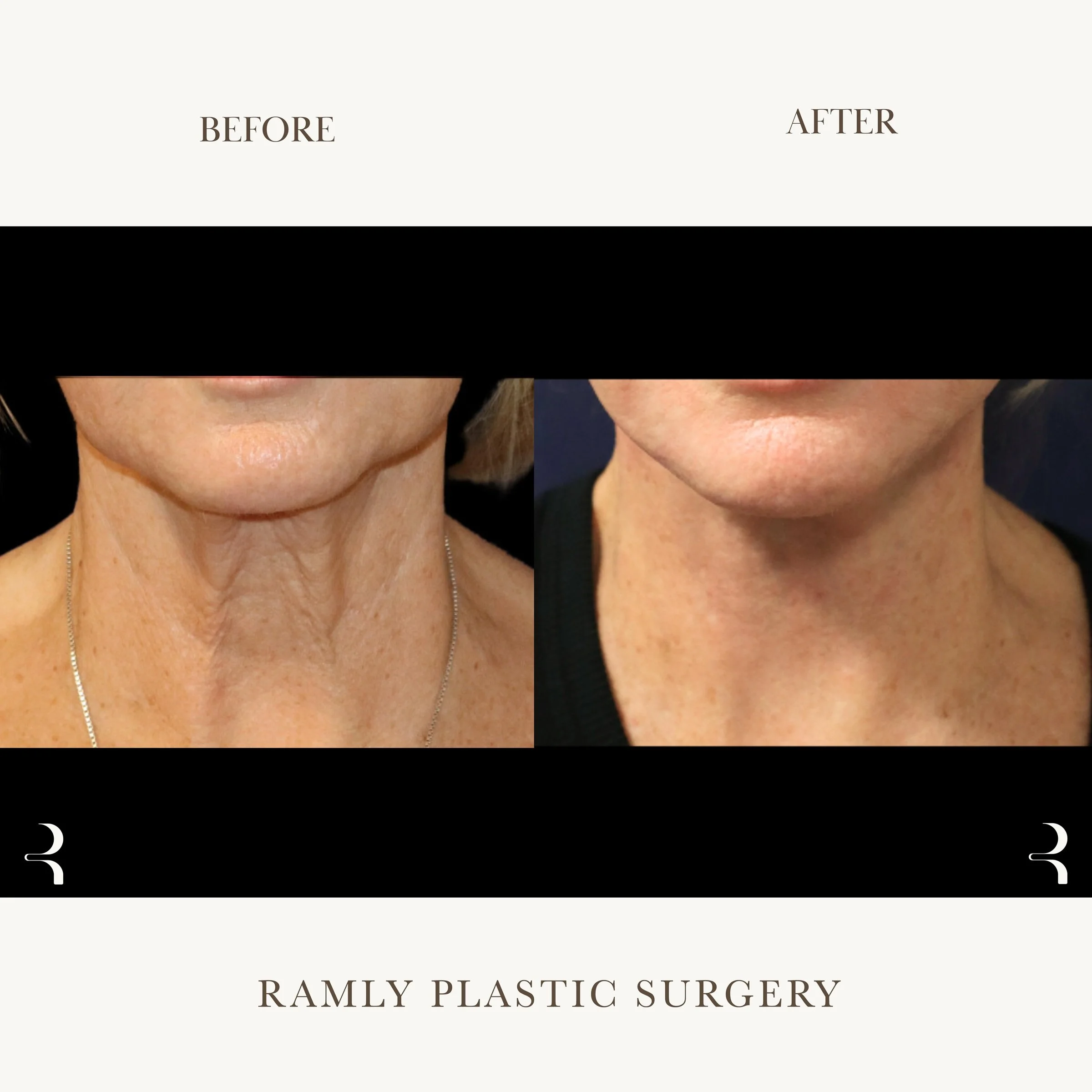 Facelift and Neck Lift Beverly Hills | Jawline & Neck Results | Dr. Elie Ramly